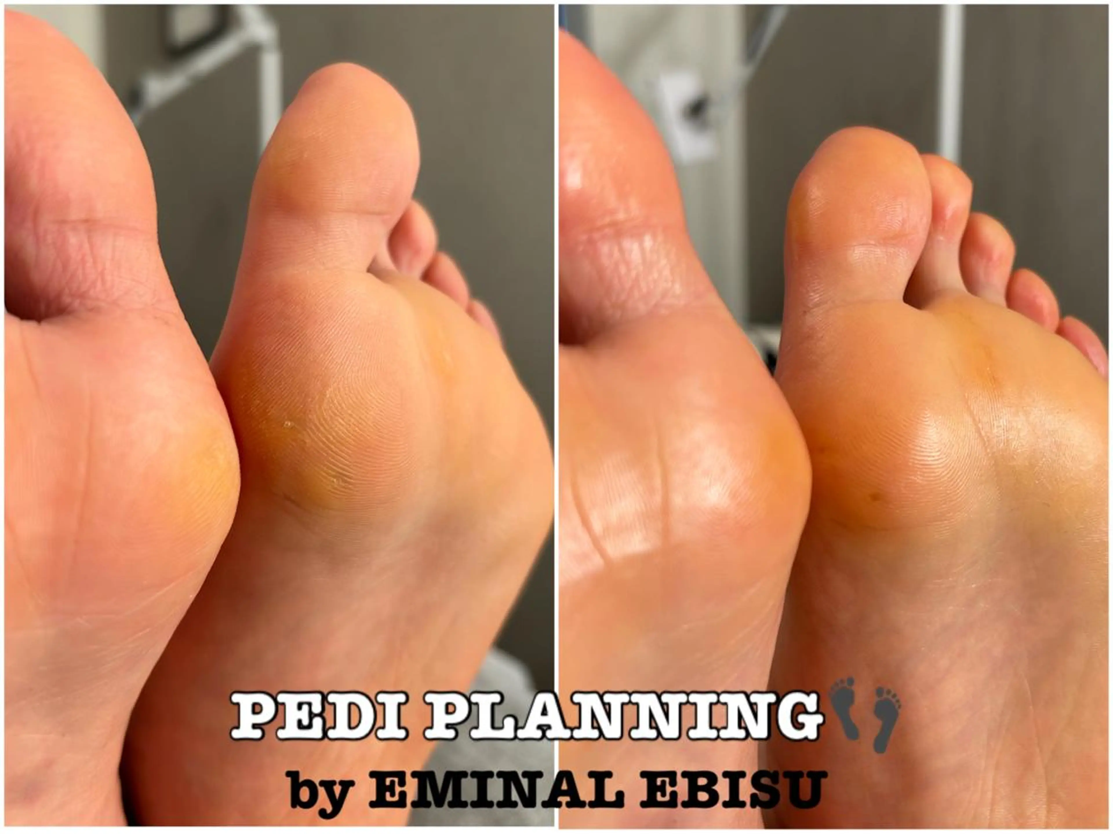 🐬🫧つるつる足裏🤍韓国式足裏角質ケア👣⸒⸒ペディプランニング🎐🩵🫧𓈒𓏸🪽《フットケア》の写真