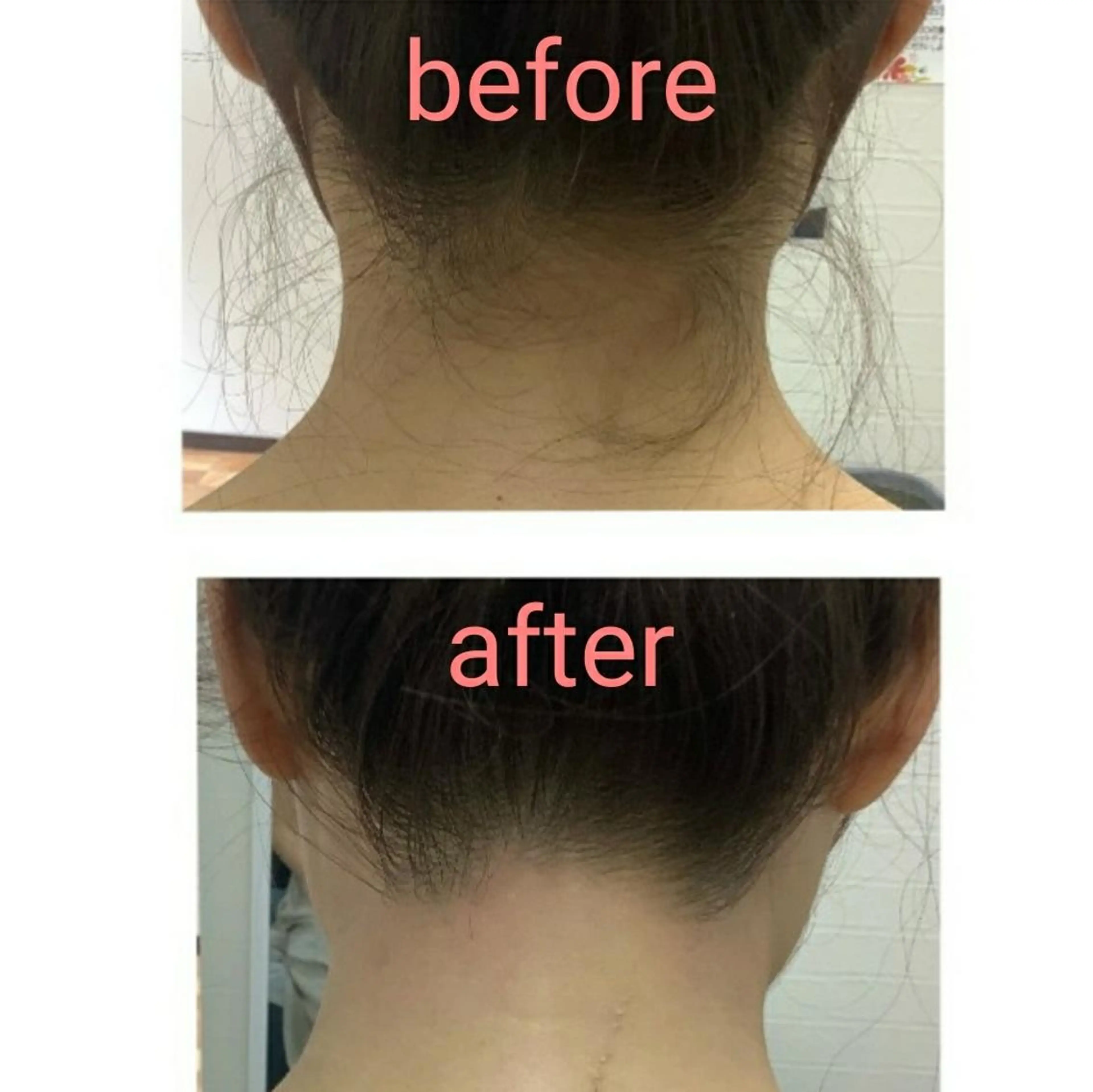 《うなじワックス脱毛》その日にキレイに☆の写真