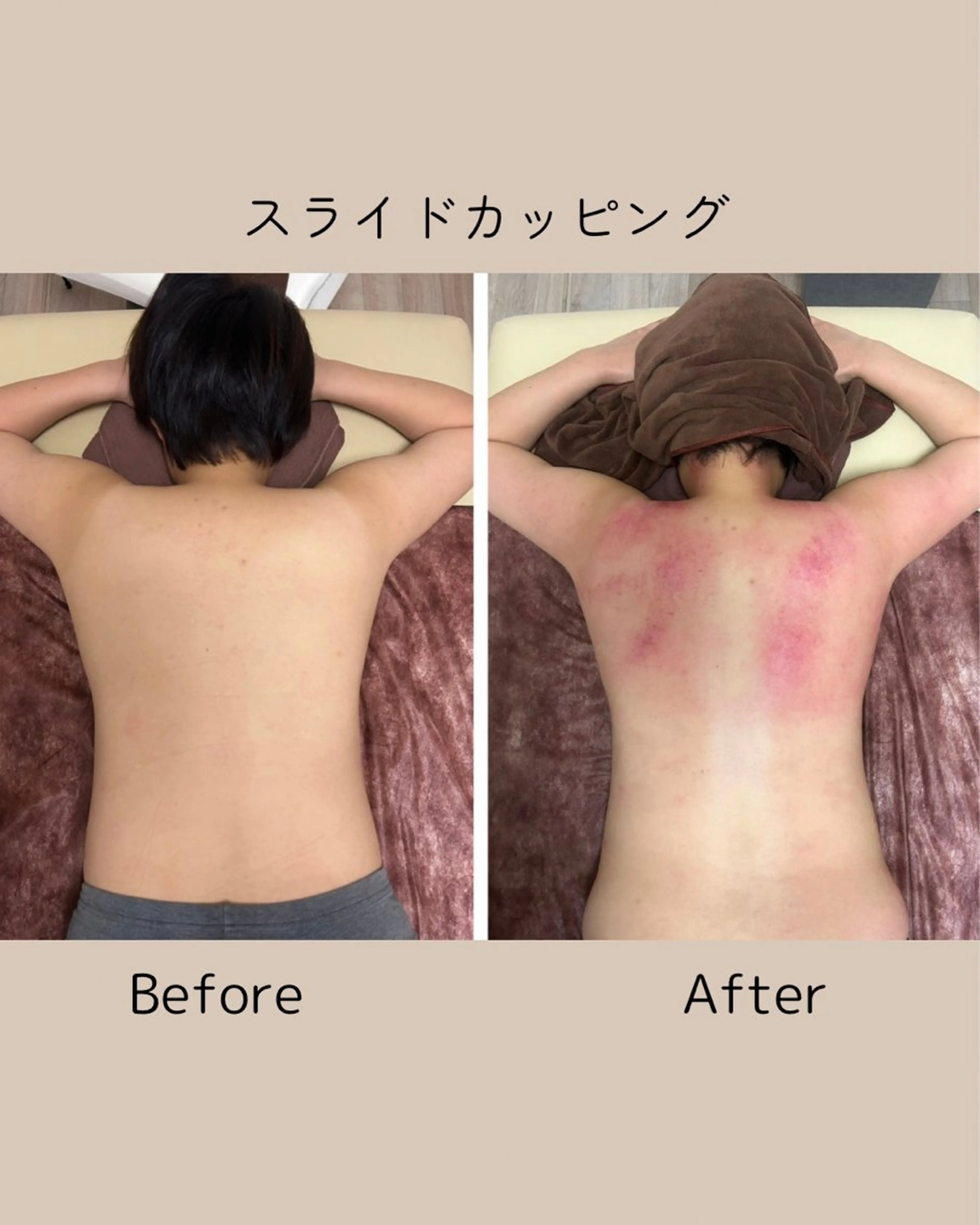 背中痩せ / 首肩こり / 小顔効果✨スライドカッピング 上半身の写真