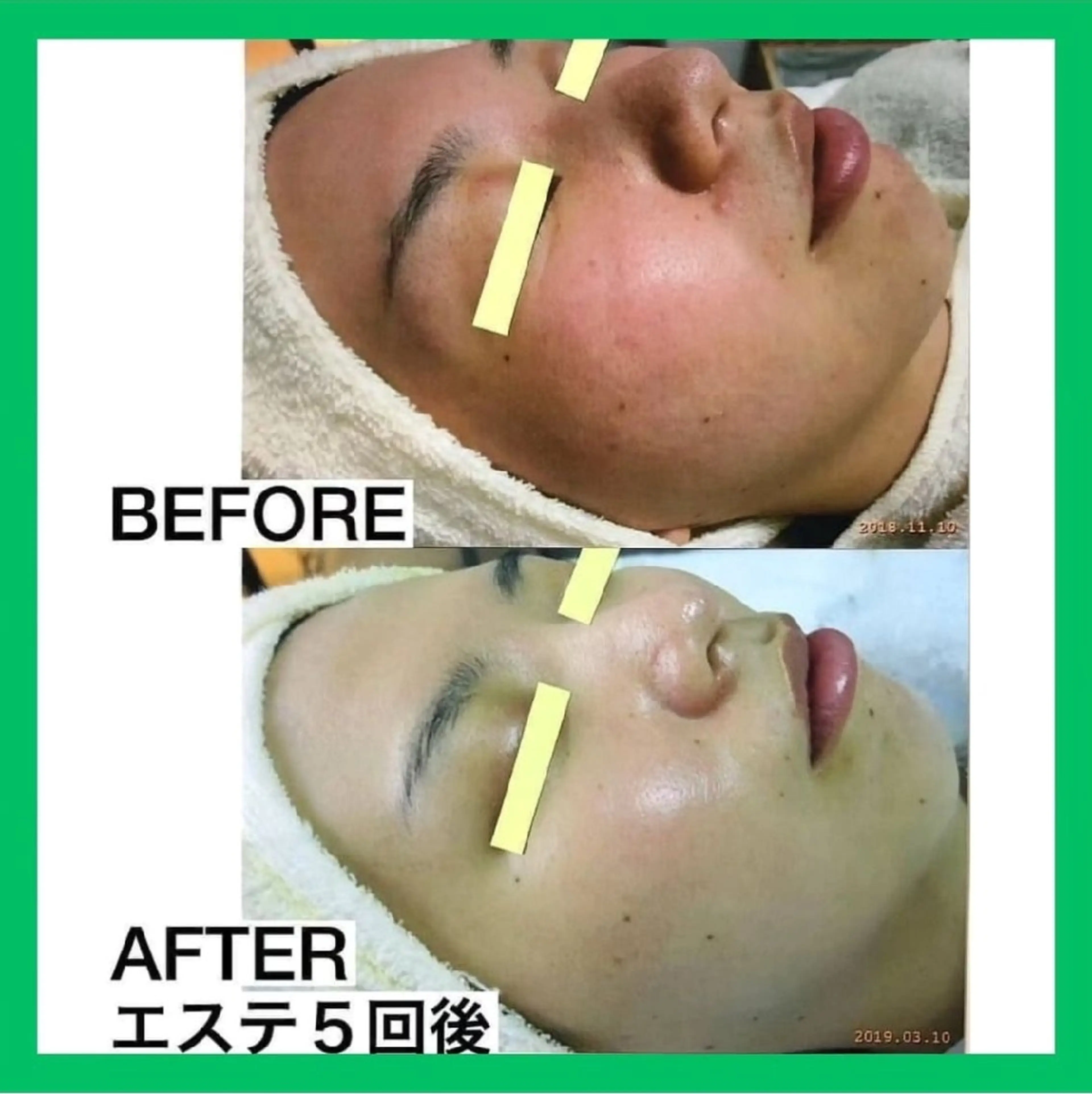 エステ ニキビケア◇ニキビ跡 レゾン京橋店 峠山のエステ・リラクイメージ