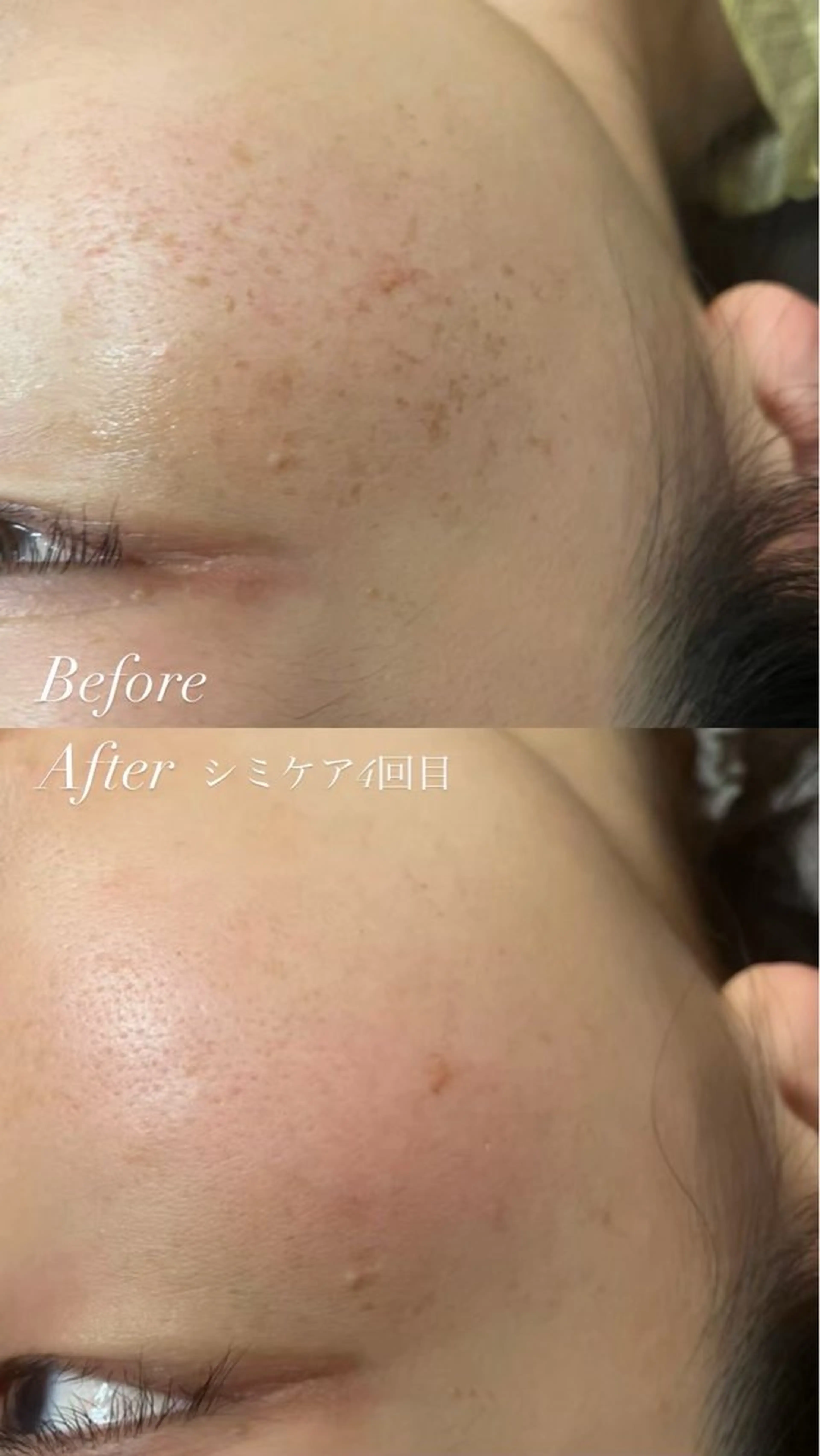 【新メニュー🎀】 シミケアの写真