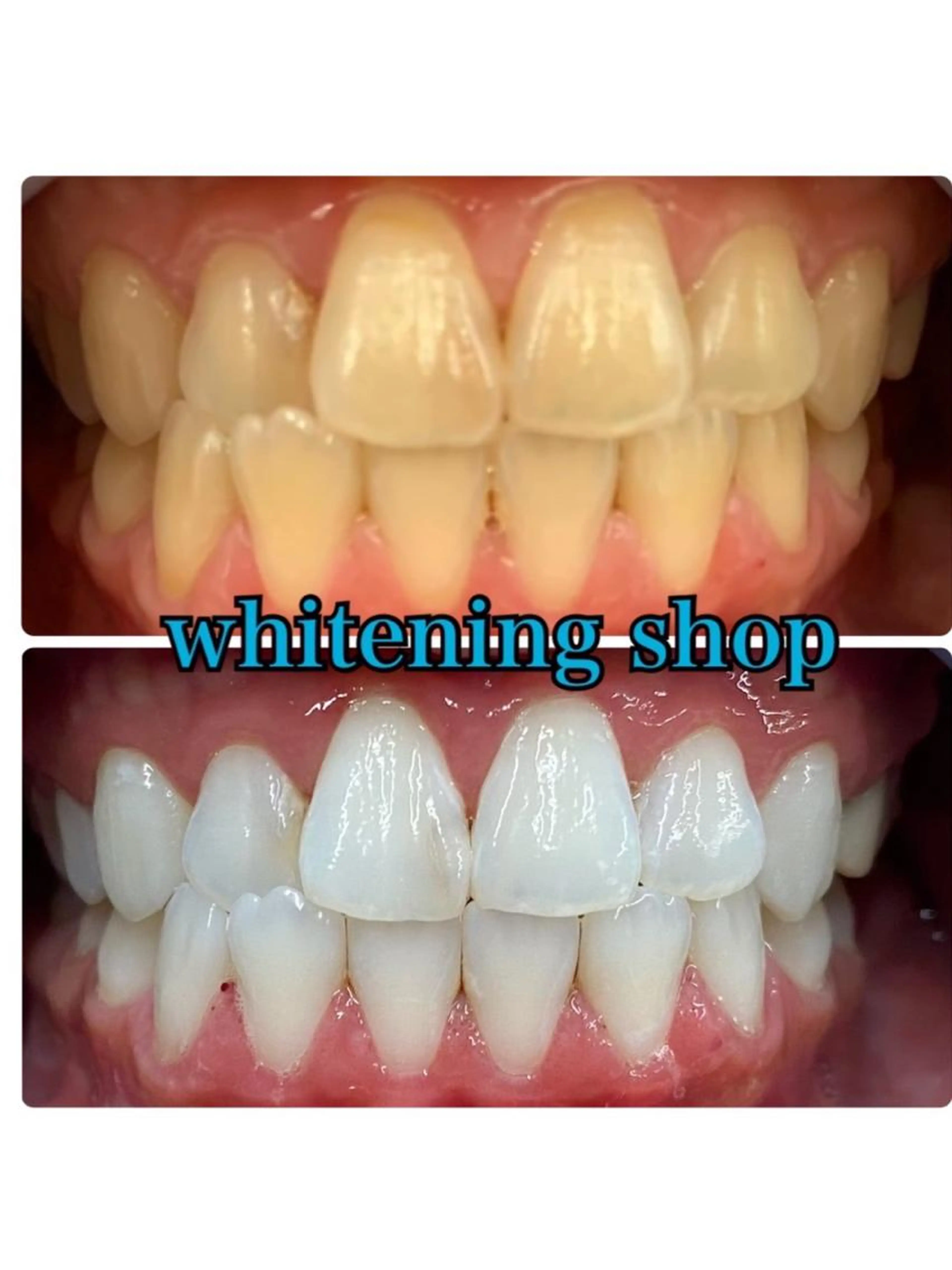 【20分×6回】しっかり白くしたい人におすすめ🦷✨ミニモ限定で割引しちゃいます!の写真