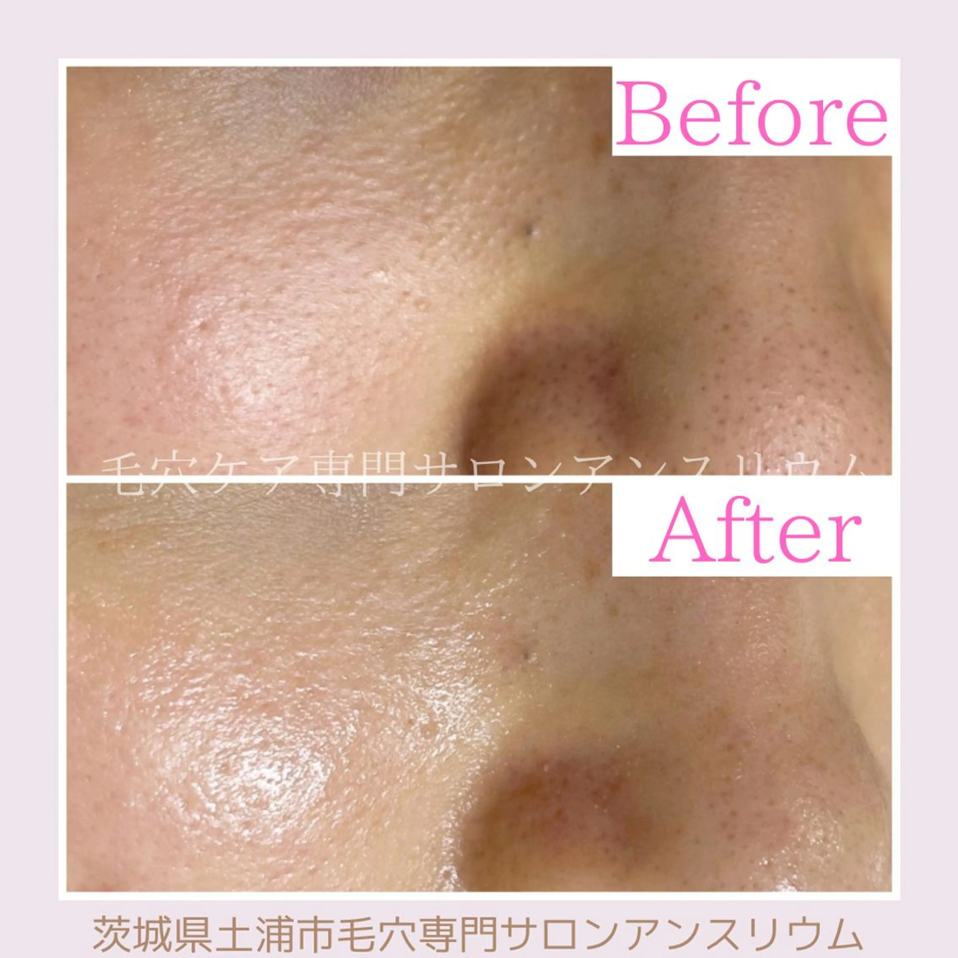 毛穴ケア専門サロンアンスリウム所属・茨城土浦 つくば毛穴 ケア専門サロンのエステ・リラクイメージ