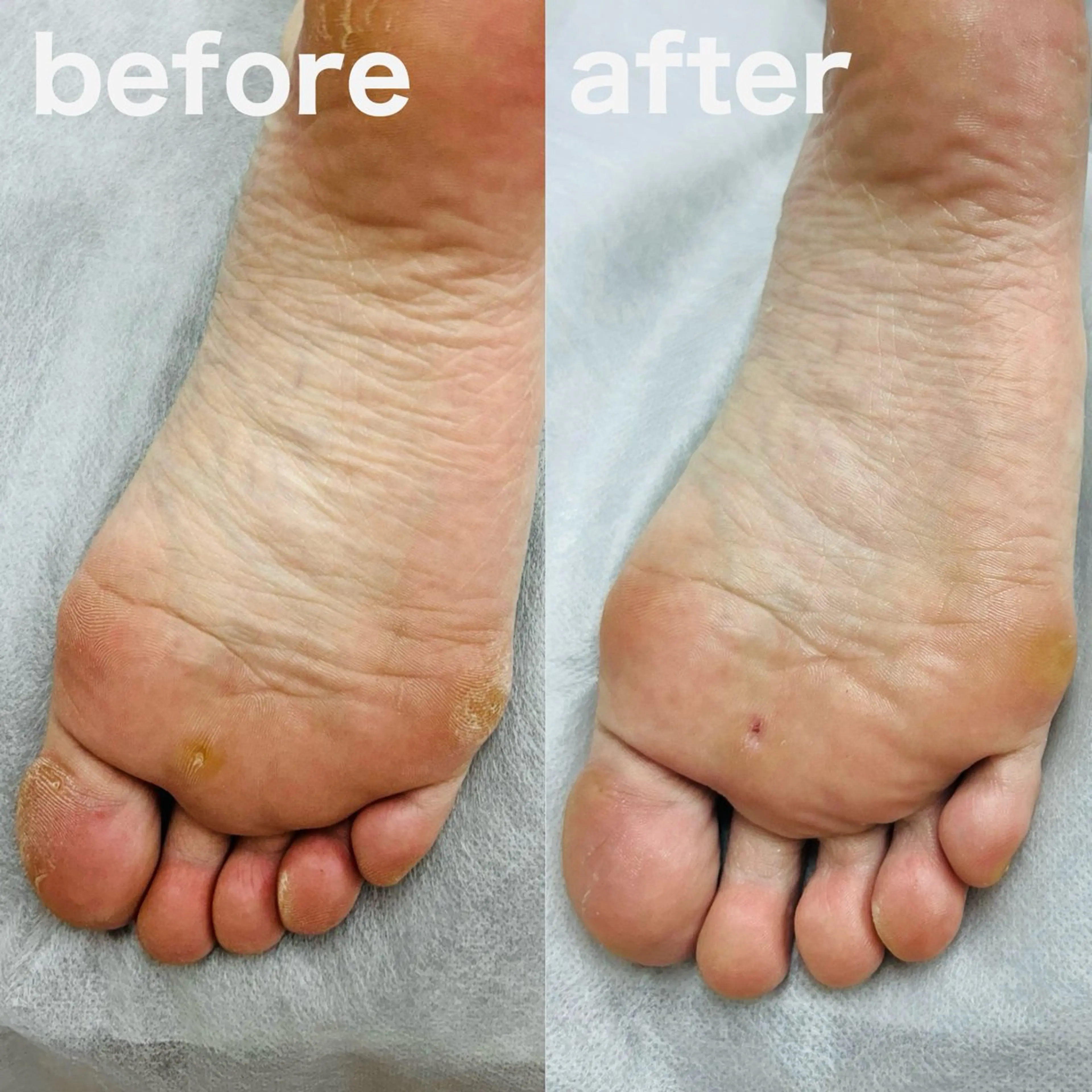 タコ・魚の目ケア30分の写真