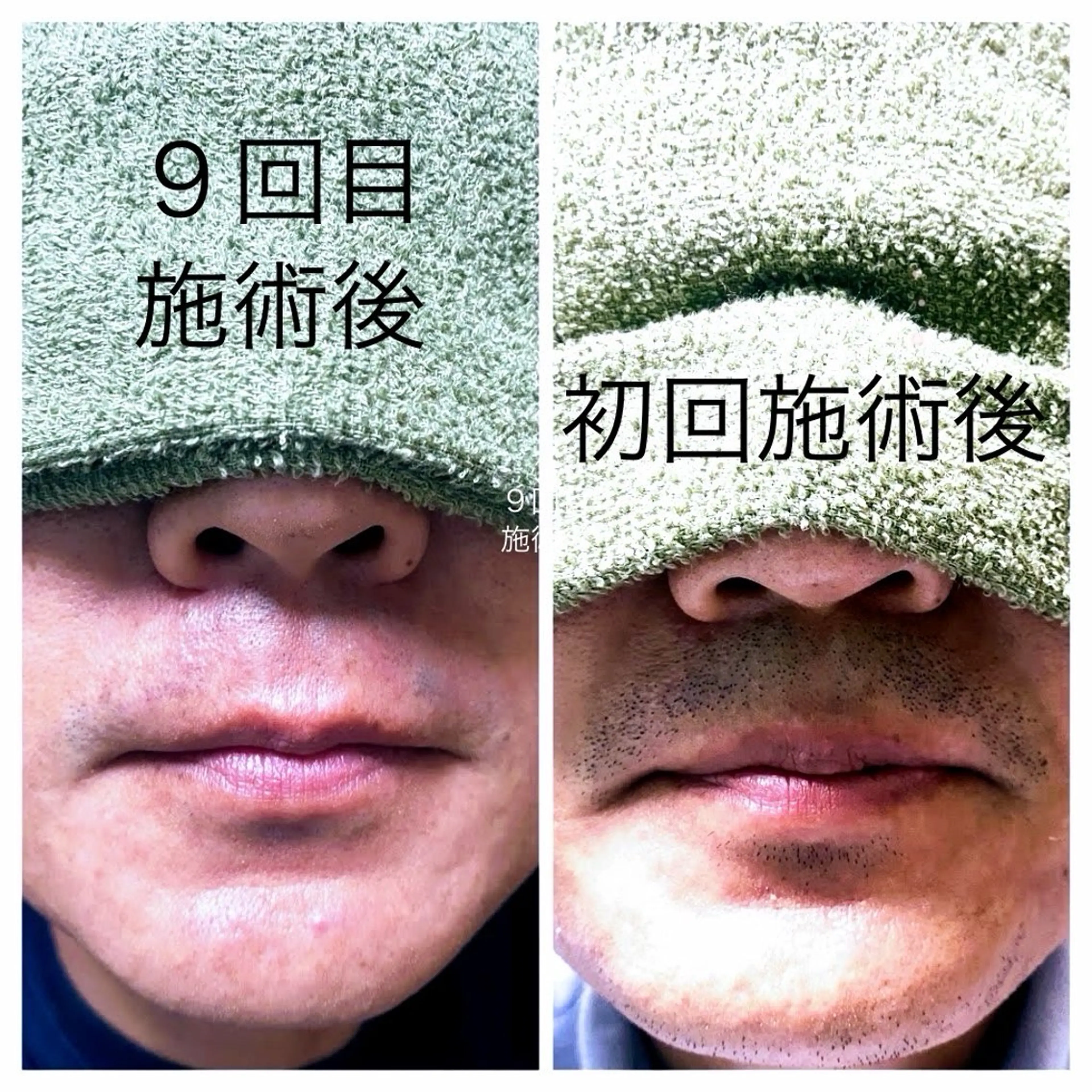 メンズ 脱毛 filer フィレールのエステ・リラクイメージ