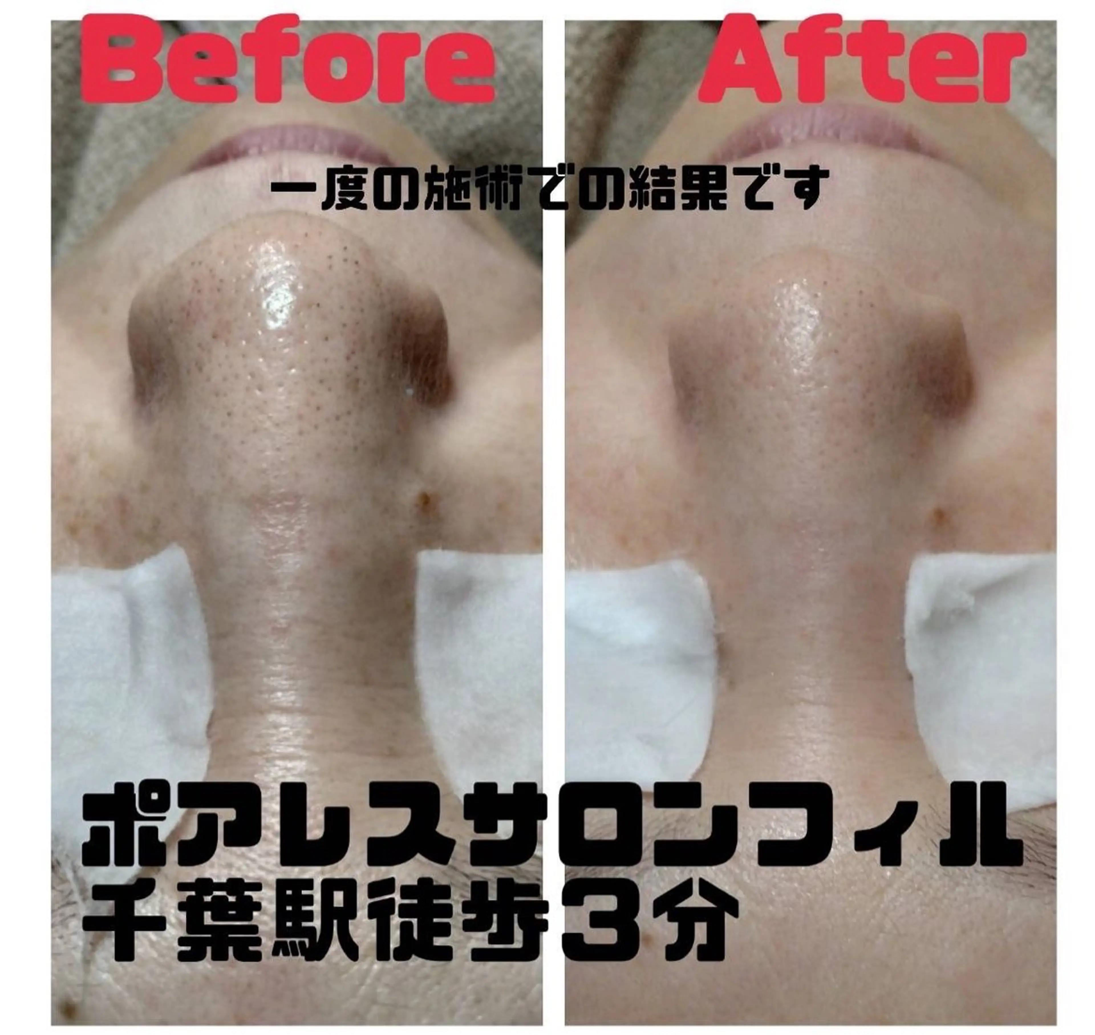 アルティメイトクイック毛穴洗浄30分＋全顔シェービング付🌷お鼻の黒ずみ気にされてる方⭕️シェービングで透明感アップ🌟の写真