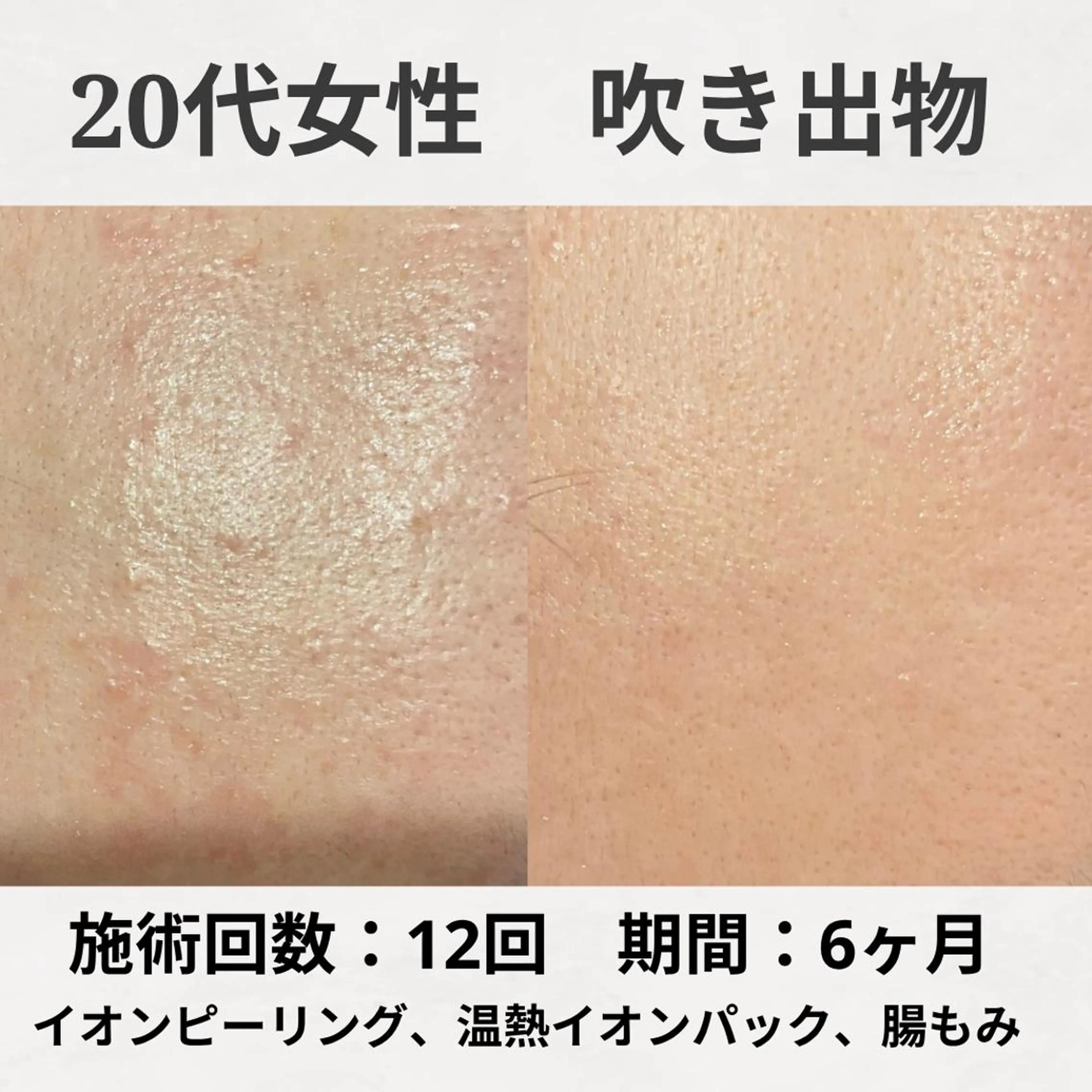 エステ リラク ニキビ跡改善専門🔥 医療にはできない改善のエステ・リラクイメージ