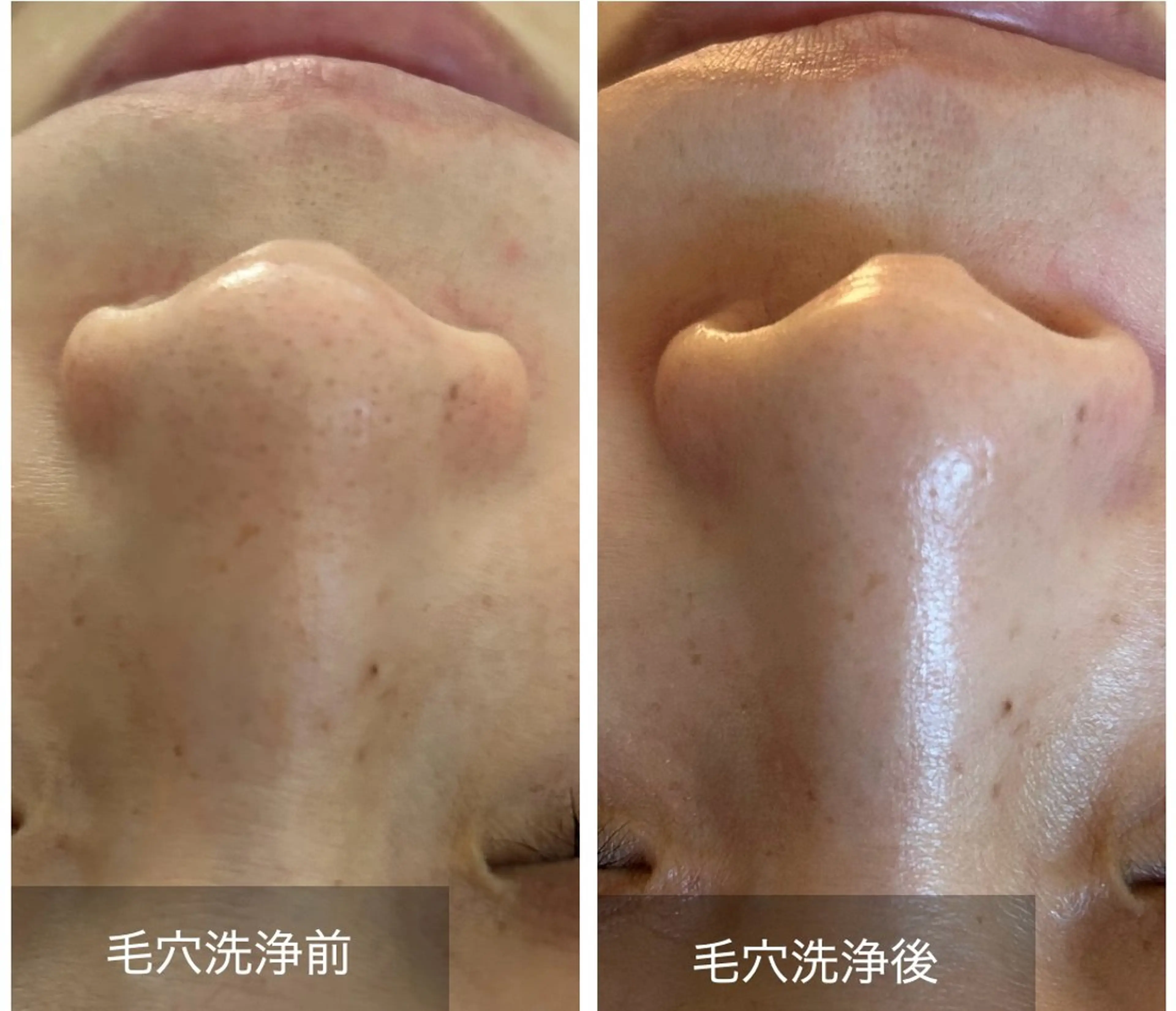 毛穴大掃除！毛穴の汚れを浮き出して、ツルツルにしませんか？の写真