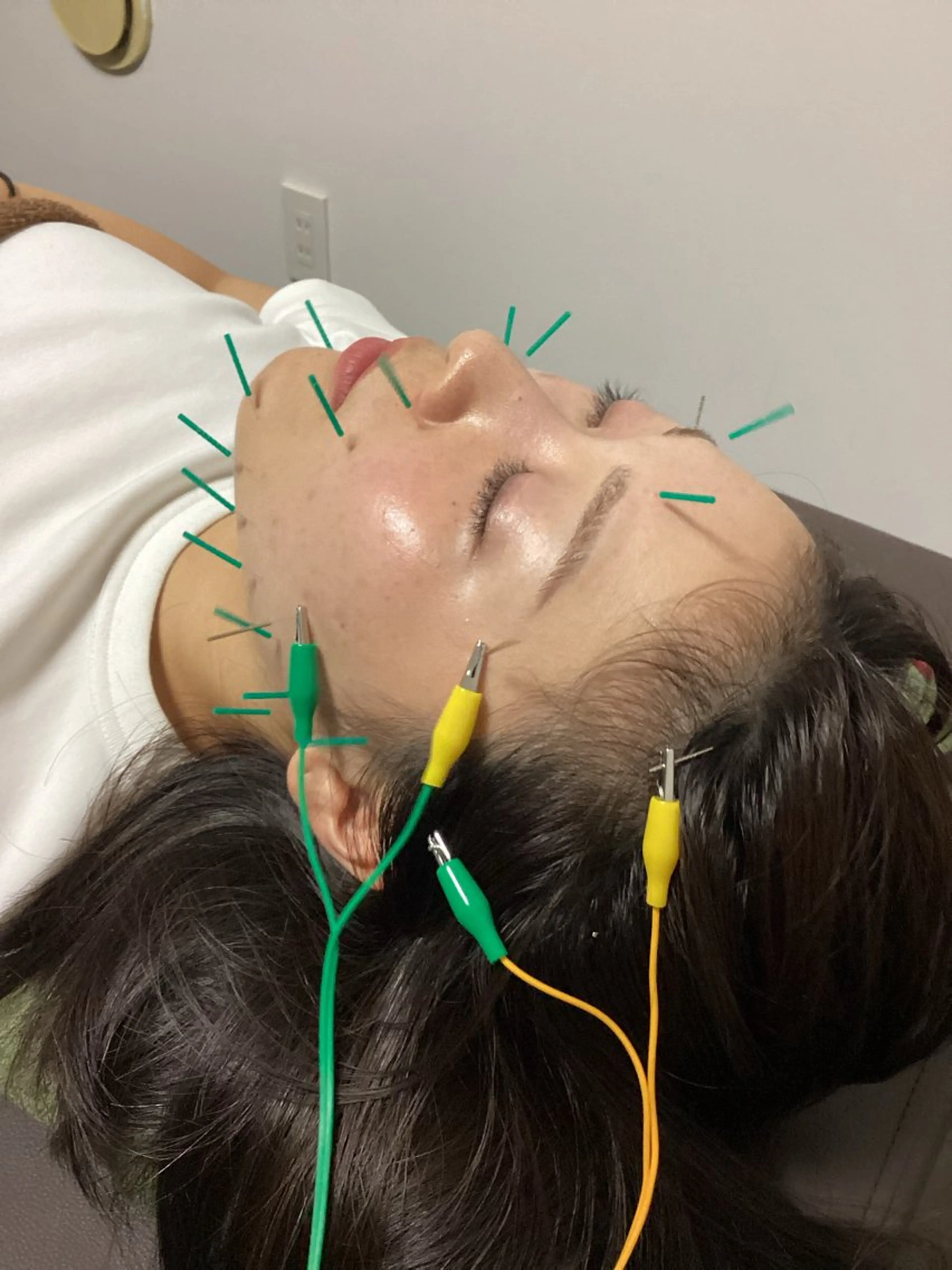 《美容鍼＋整体》選べる施術つき90分コースの写真