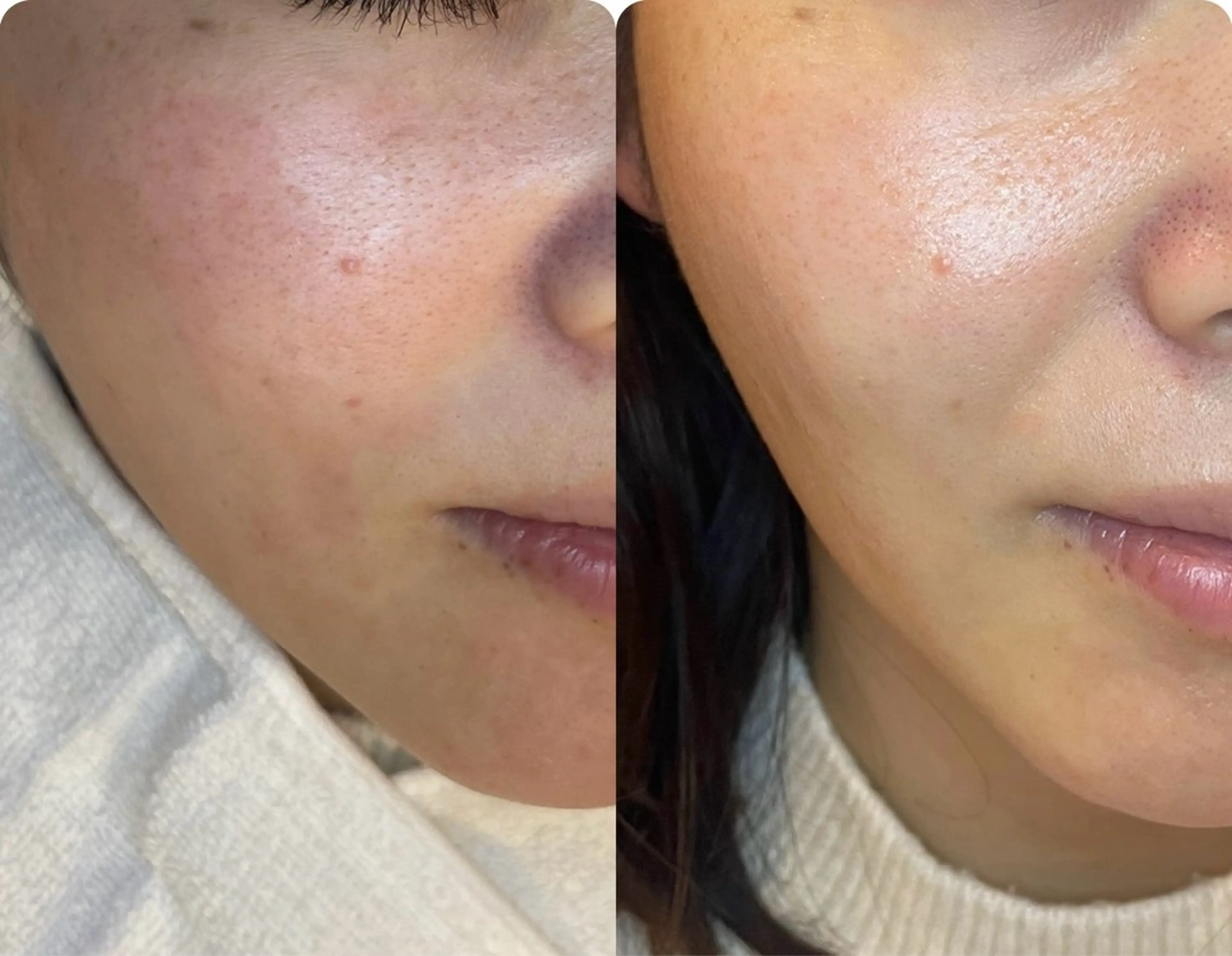 くすみ、たるみが気になっている方にオススメ💫リフトアップ×イオン導入（BeforeAfter写真にご協力頂ける方限定）の写真