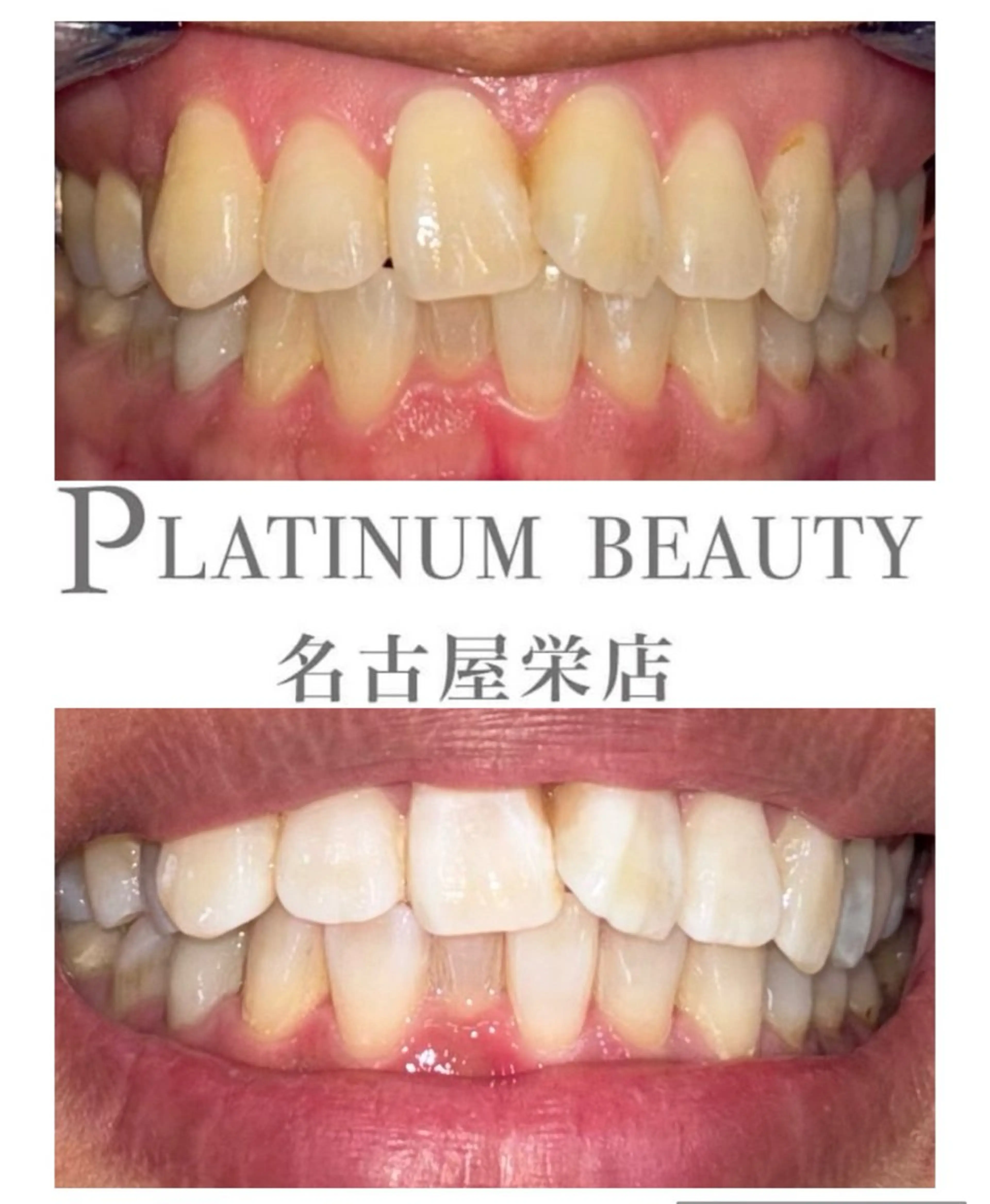 【ペア割引ホワイトニング】セルフホワイトニング〈30分照射〉の写真