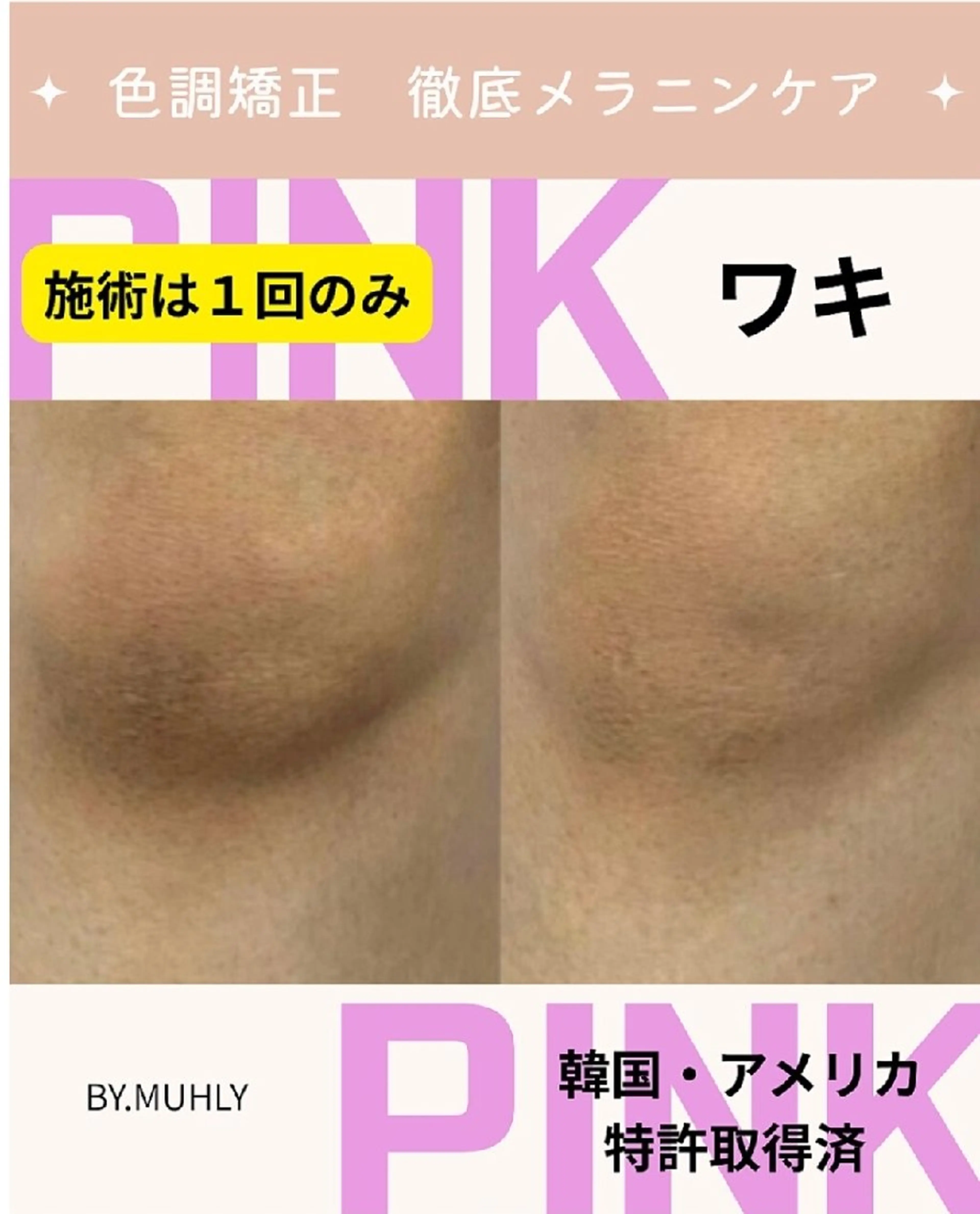 【脇】韓国発メラニンケア　BY.MUHLYの写真