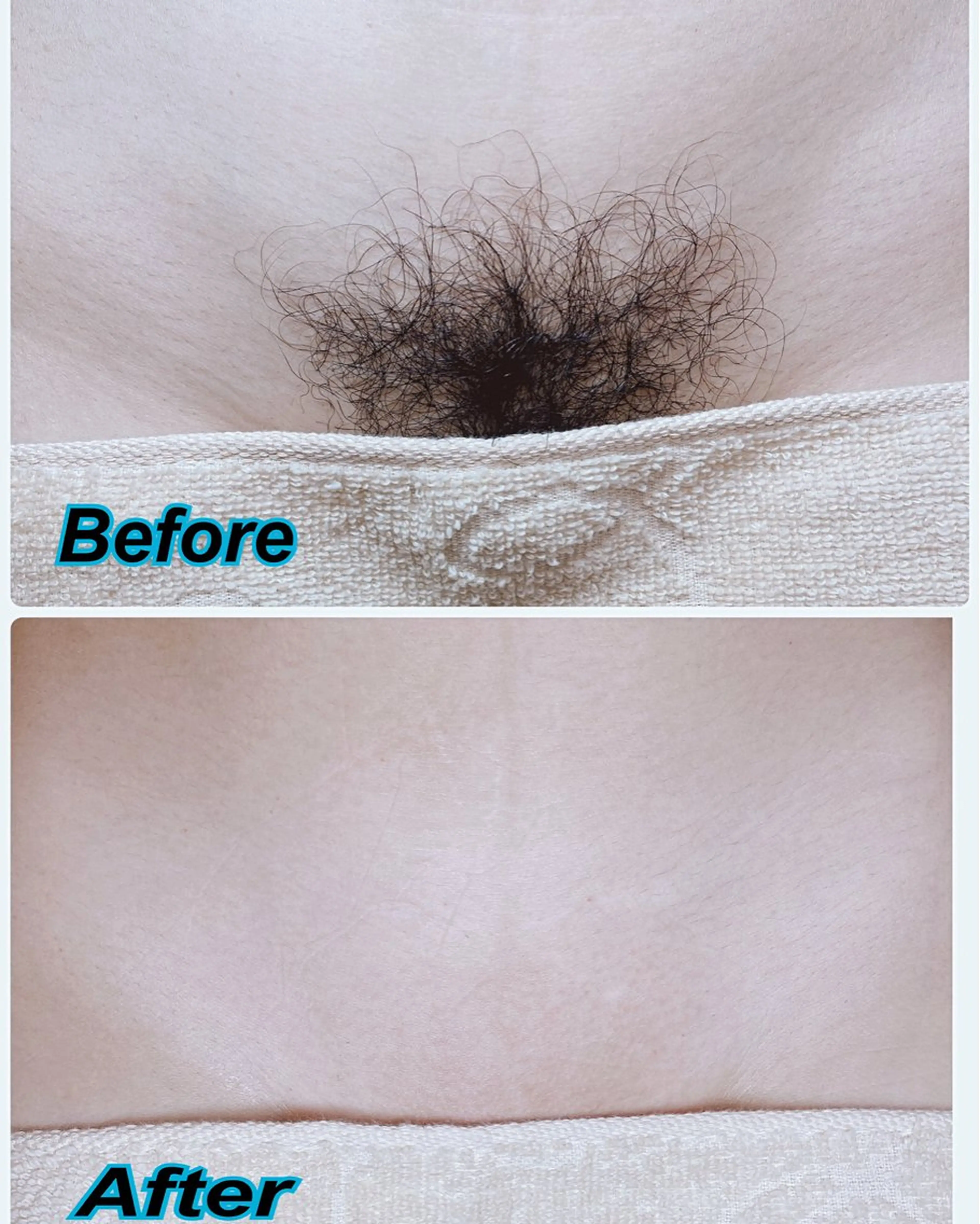 ✨🌹VIO脱毛🌹✨快適に過ごせてツルツルもちもち肌を手に入れていきましょう💕何度でもお使いいただけます☺️の写真