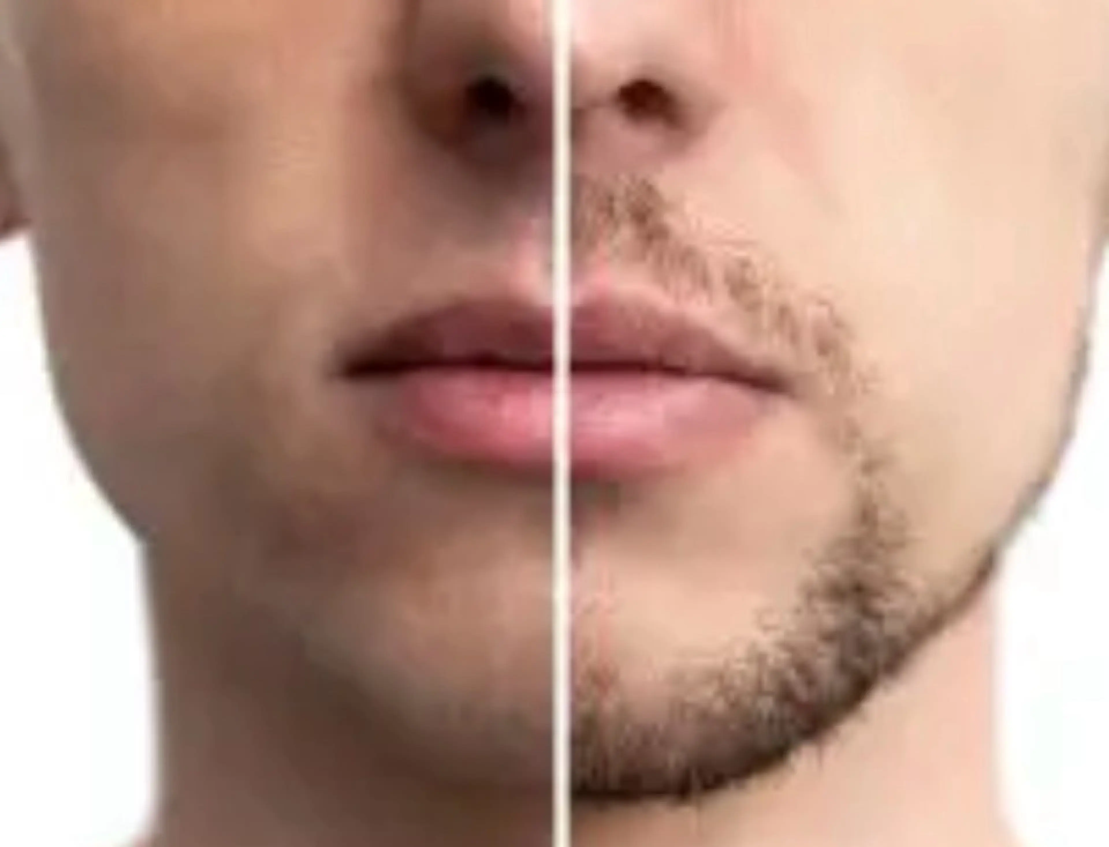 メンズひげ脱毛の写真