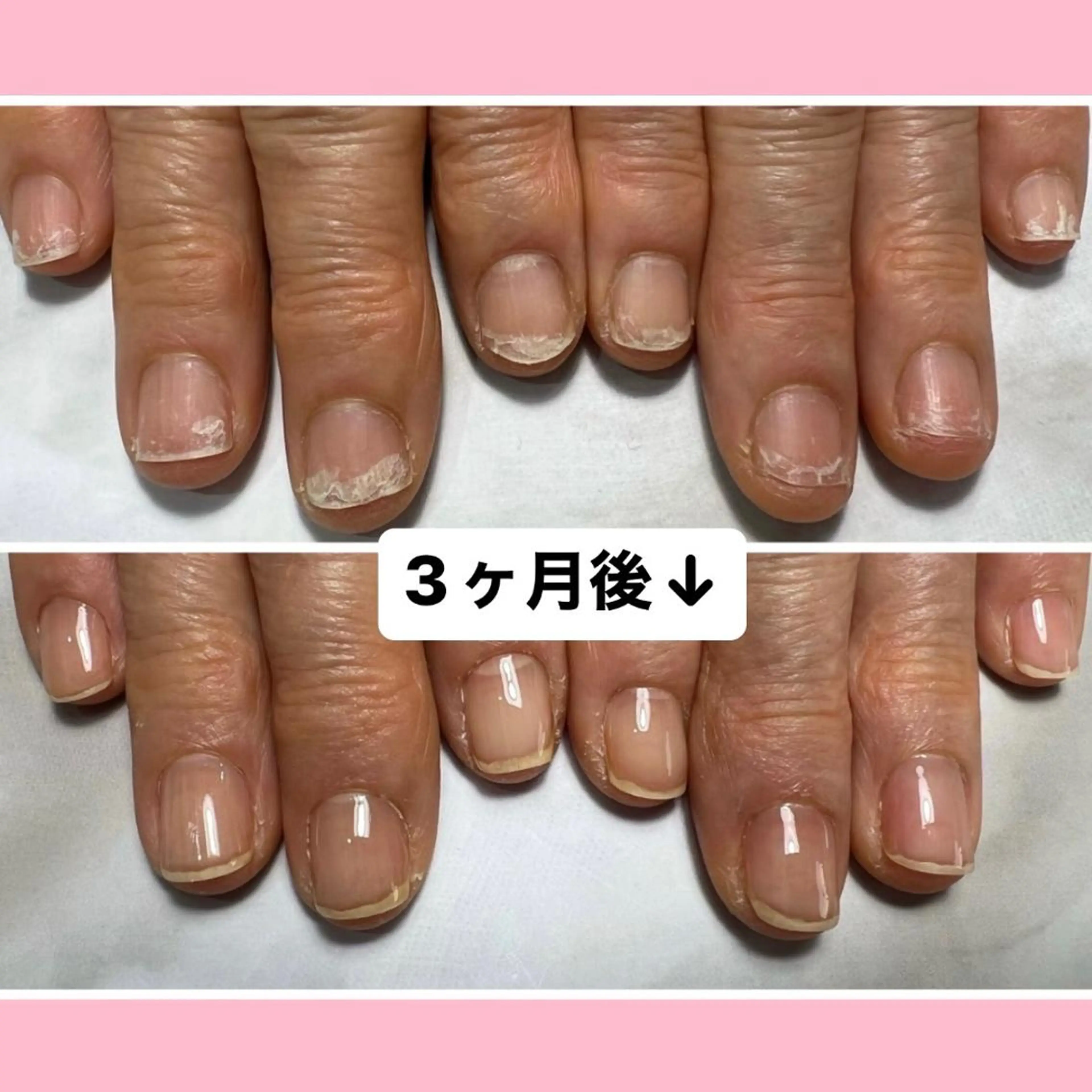 ネイル 自爪育成/深爪矯正 mikiのネイルデザイン