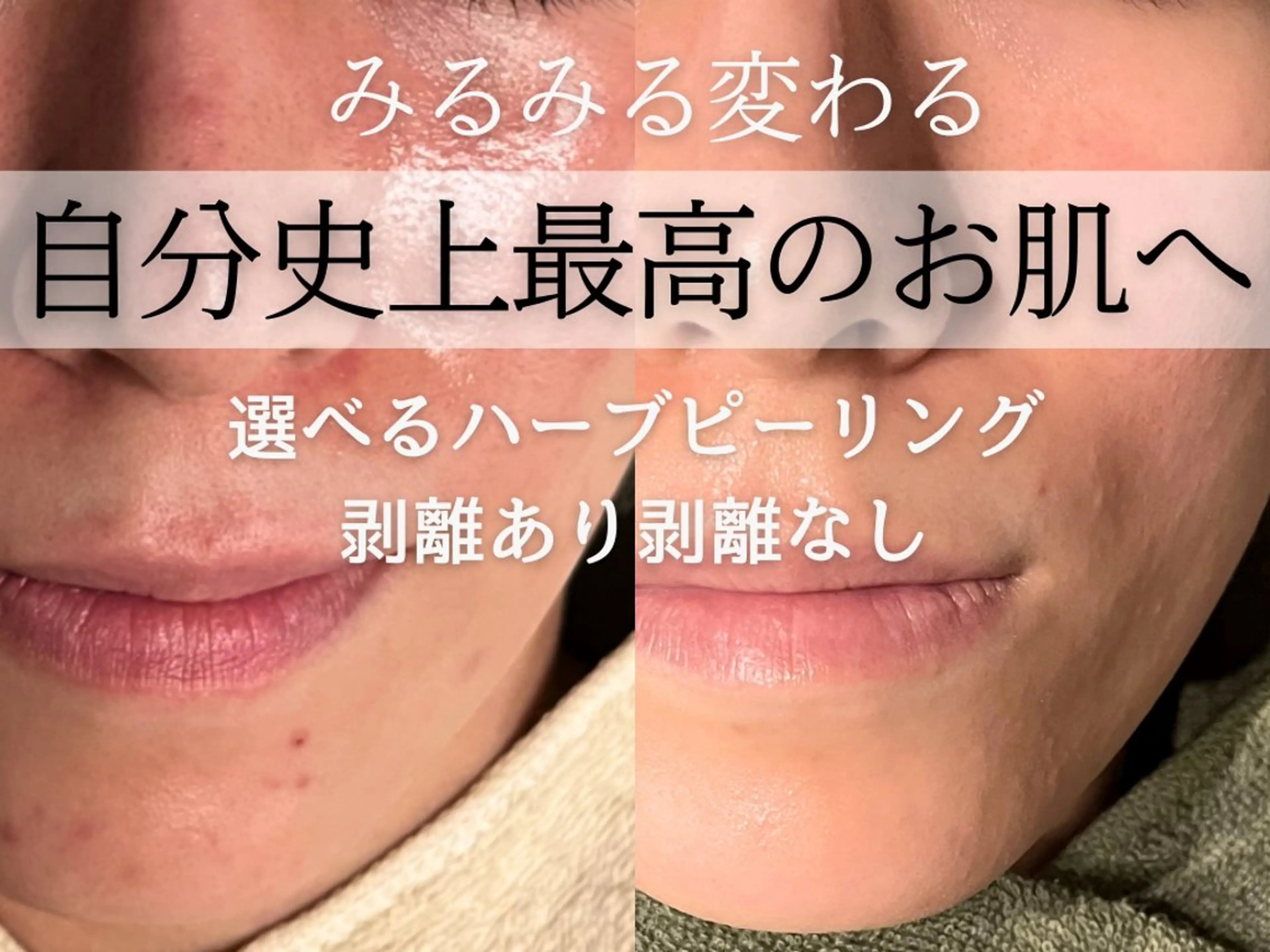 【モニター・剥離あり】ハーブピーリングの写真