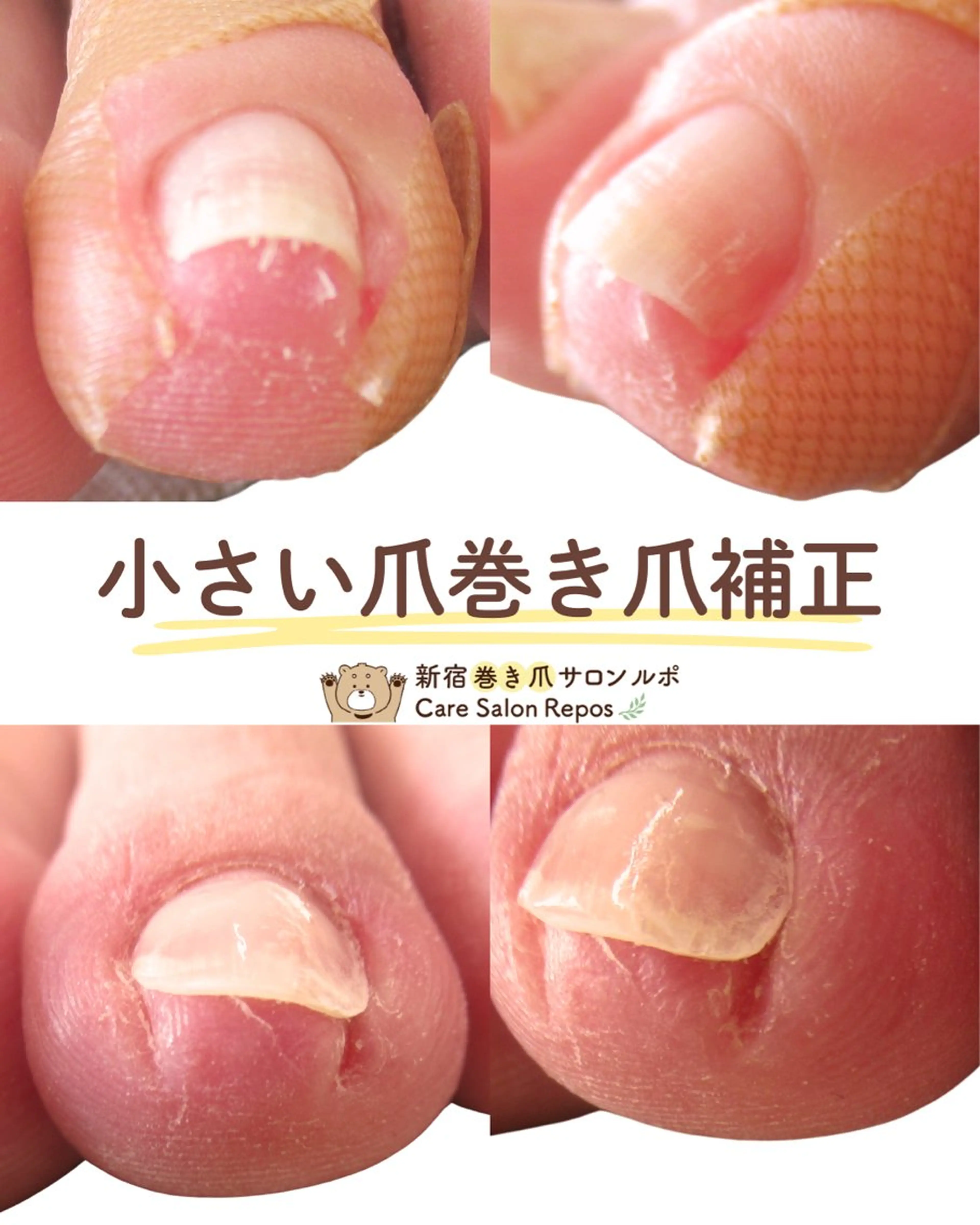 5月末まで！モニター様価格【小さい爪の巻き爪補正（指1本）　2,200円】の写真