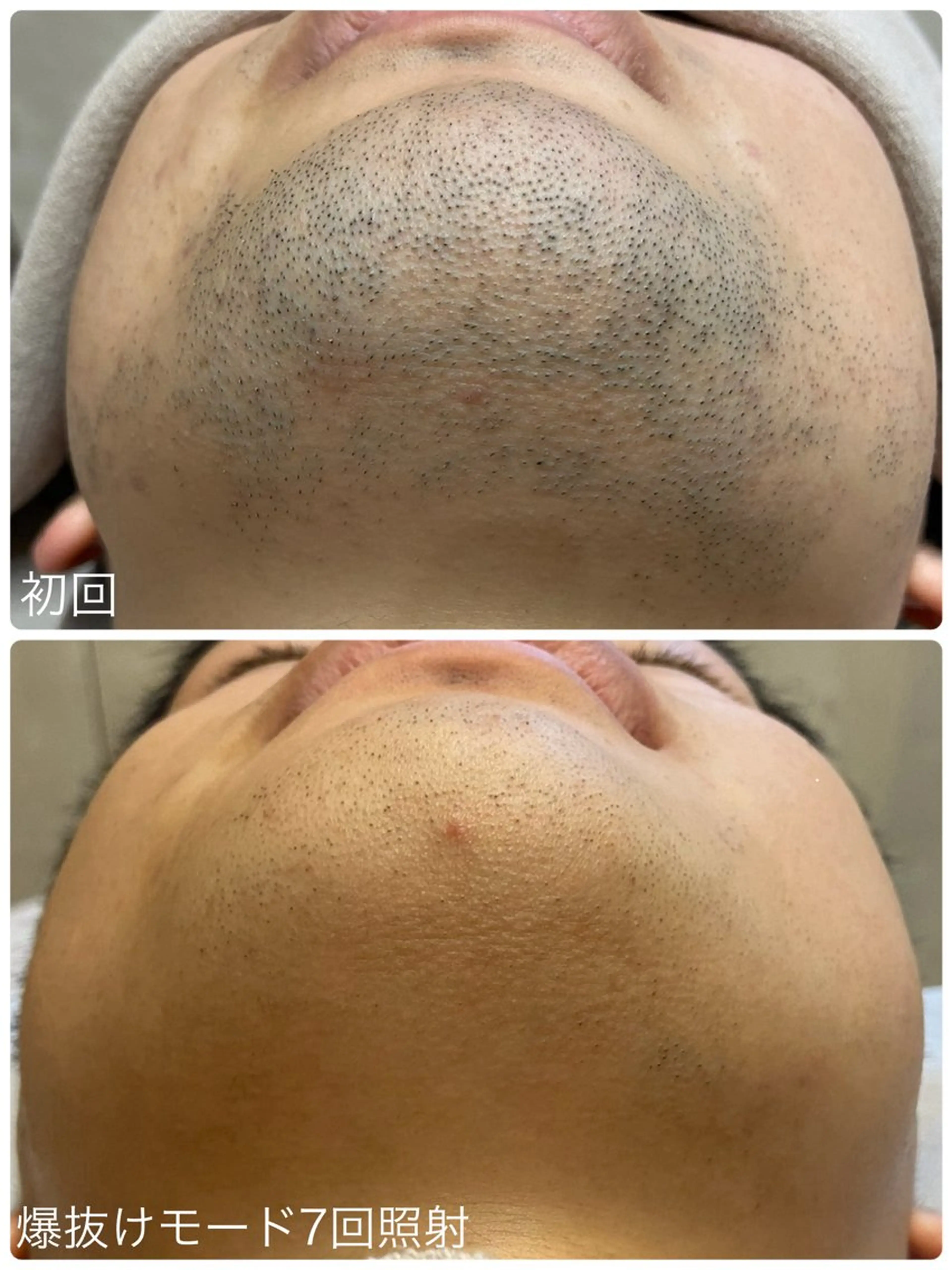 脱毛 Hisui 小出のエステ・リラクイメージ