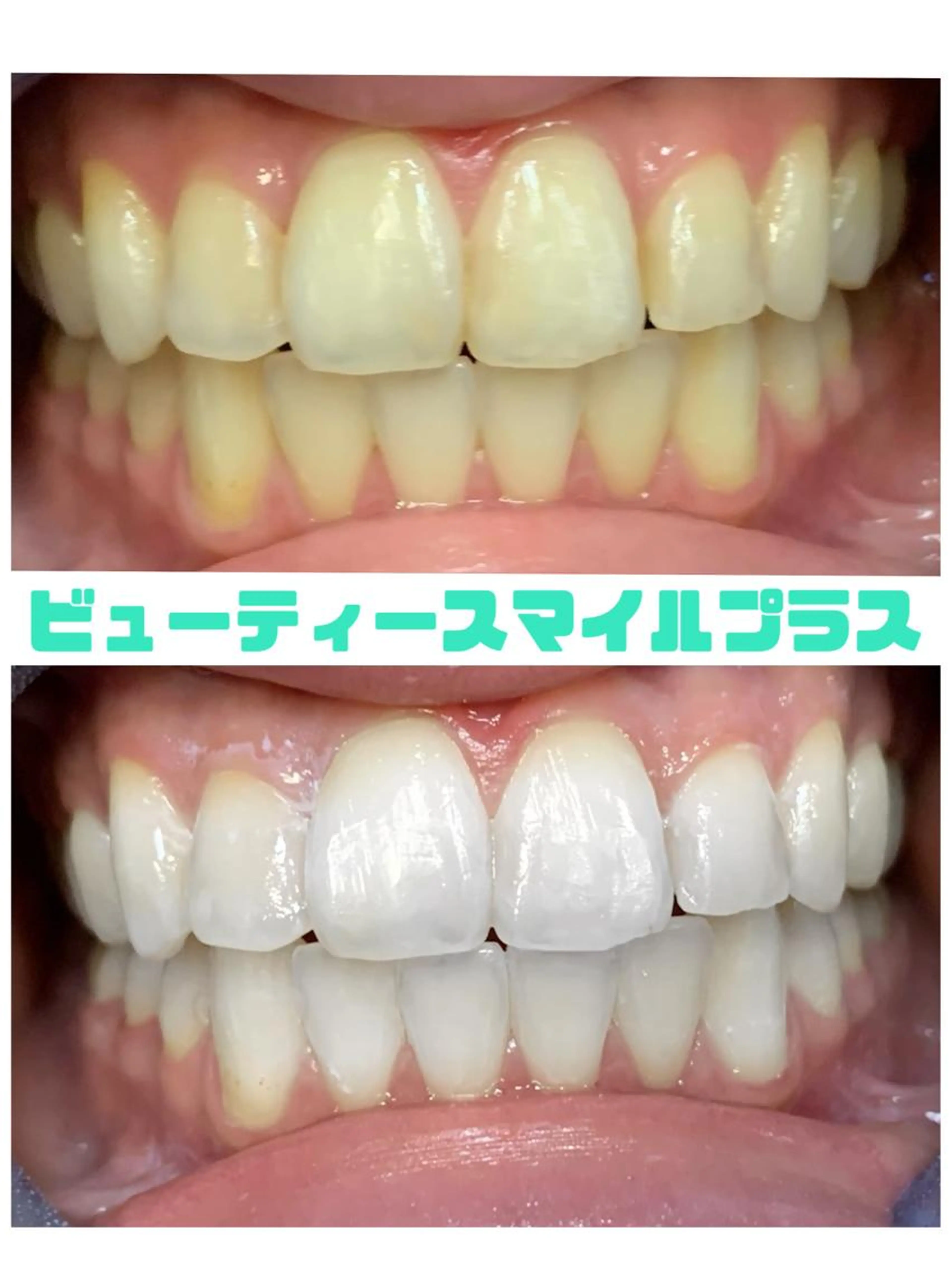 アイリンダホワイトニング 12分×2セット　¥11,000→¥6,600の写真