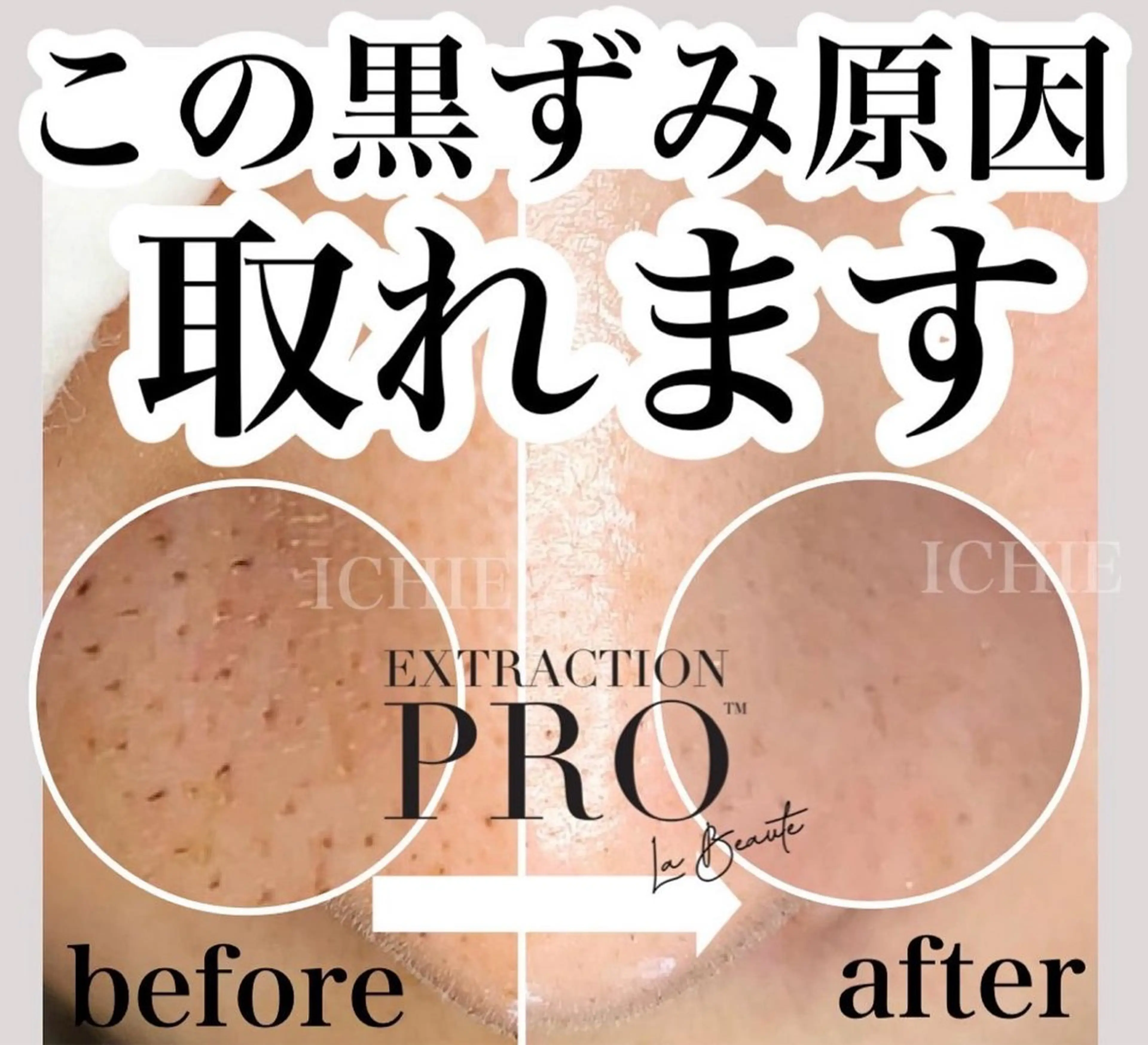 【毛穴美人】毛穴エクストラクションプロ(ヘッドスパorデコルテ付)の写真