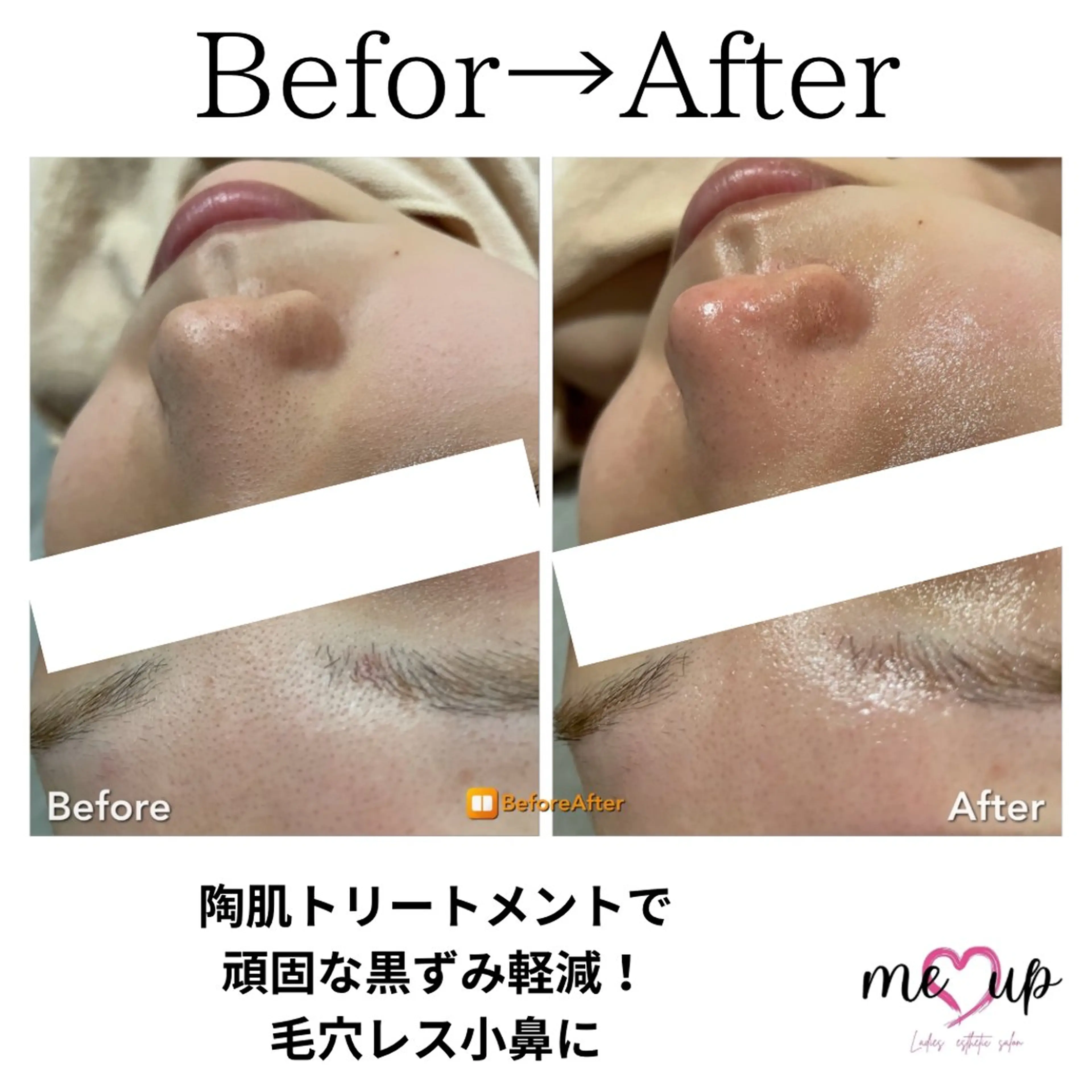 エステ Meupニキビ専門店 背中/ハーブ/肌管理のその他イメージ