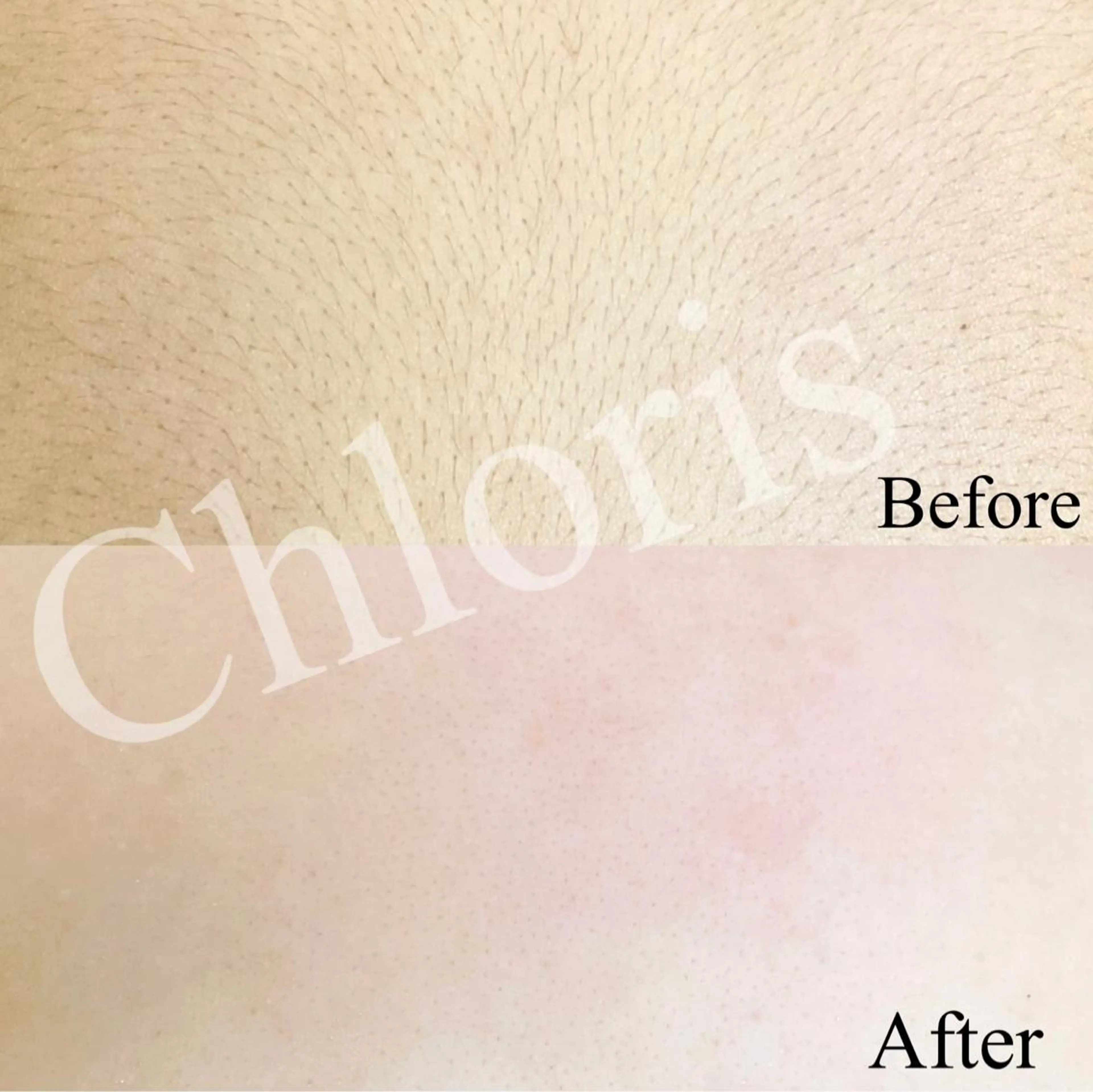 川越デリケートゾーン 光脱毛/ワックス脱毛のエステ・リラクイメージ