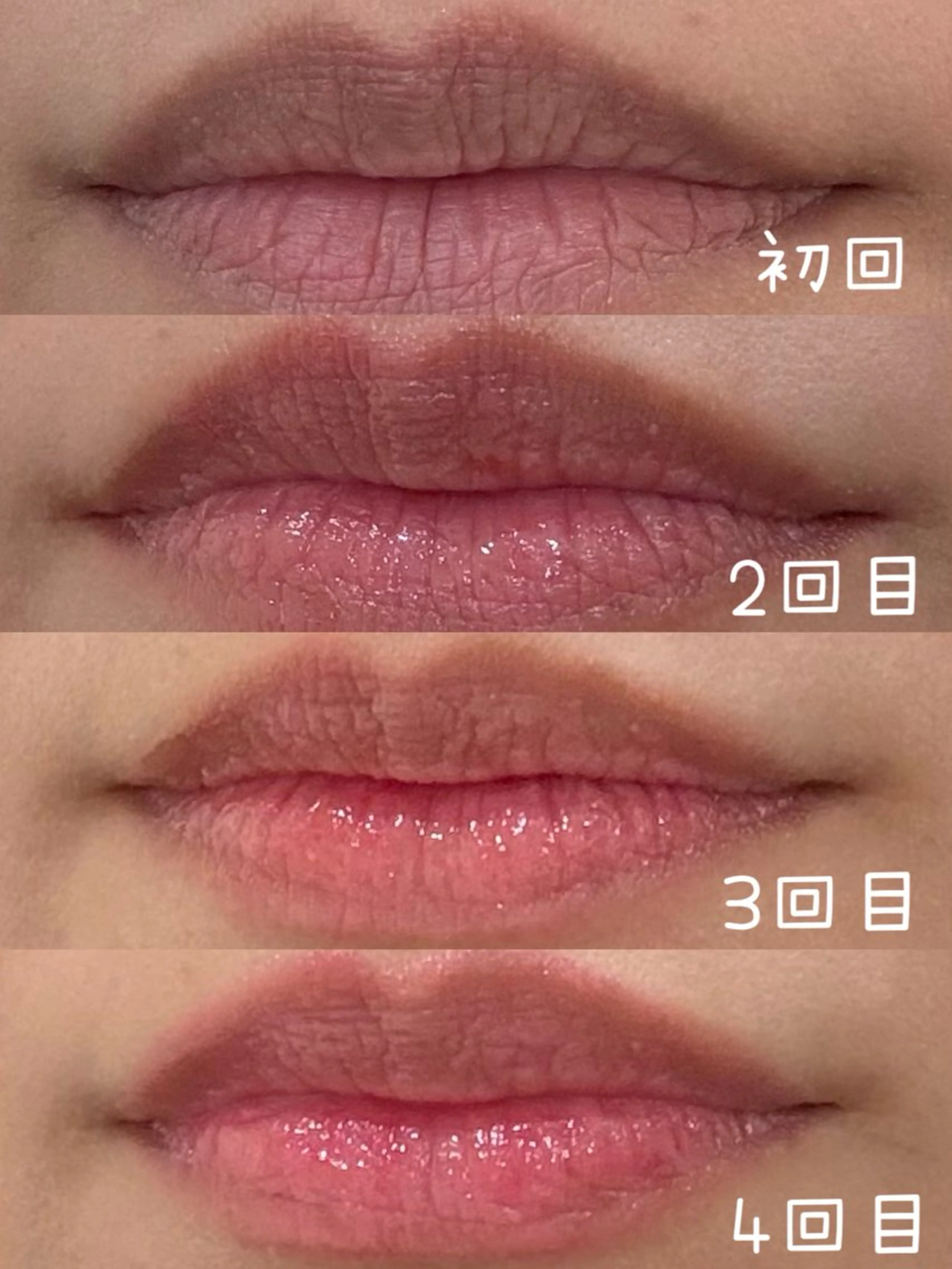 メラニンケア♦︎唇 ¥5,500の写真