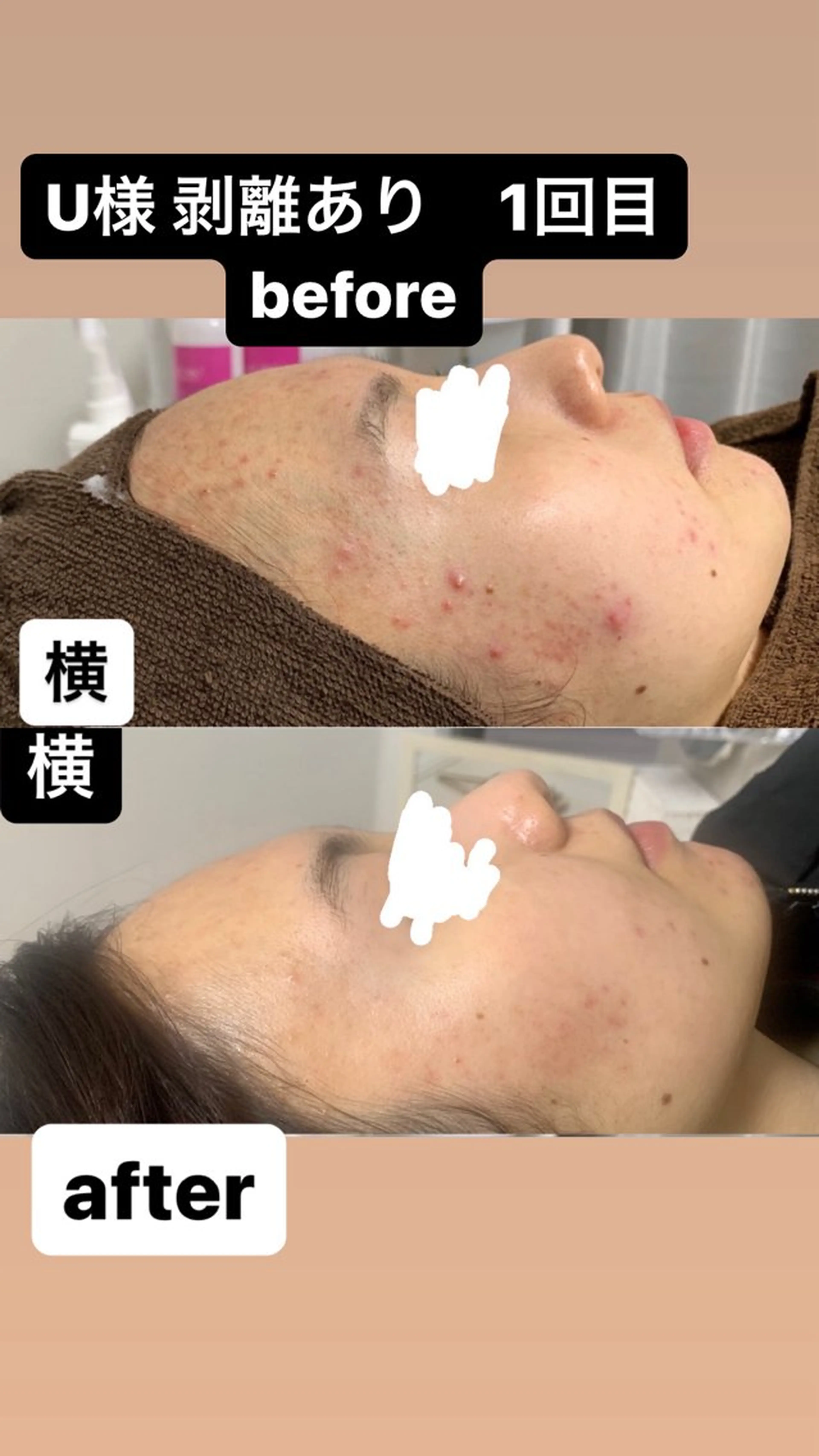 剥離あり【ニキビ、ニキビ跡にお悩みの方に】フェイシャルハーブピーリング ♪ メンズの方は絶対に剥離あり◎15000円の写真