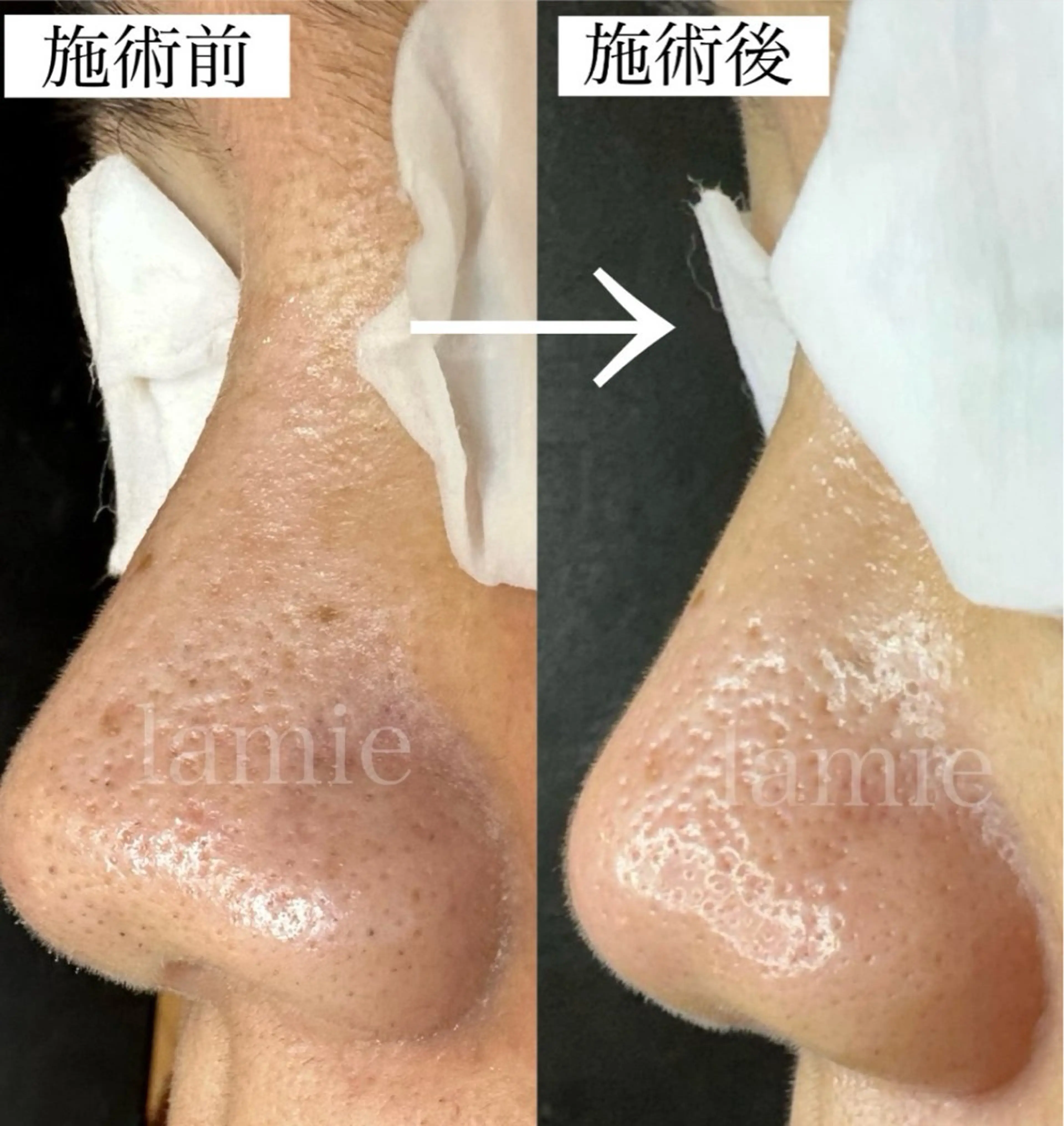 毛穴改善コースの写真