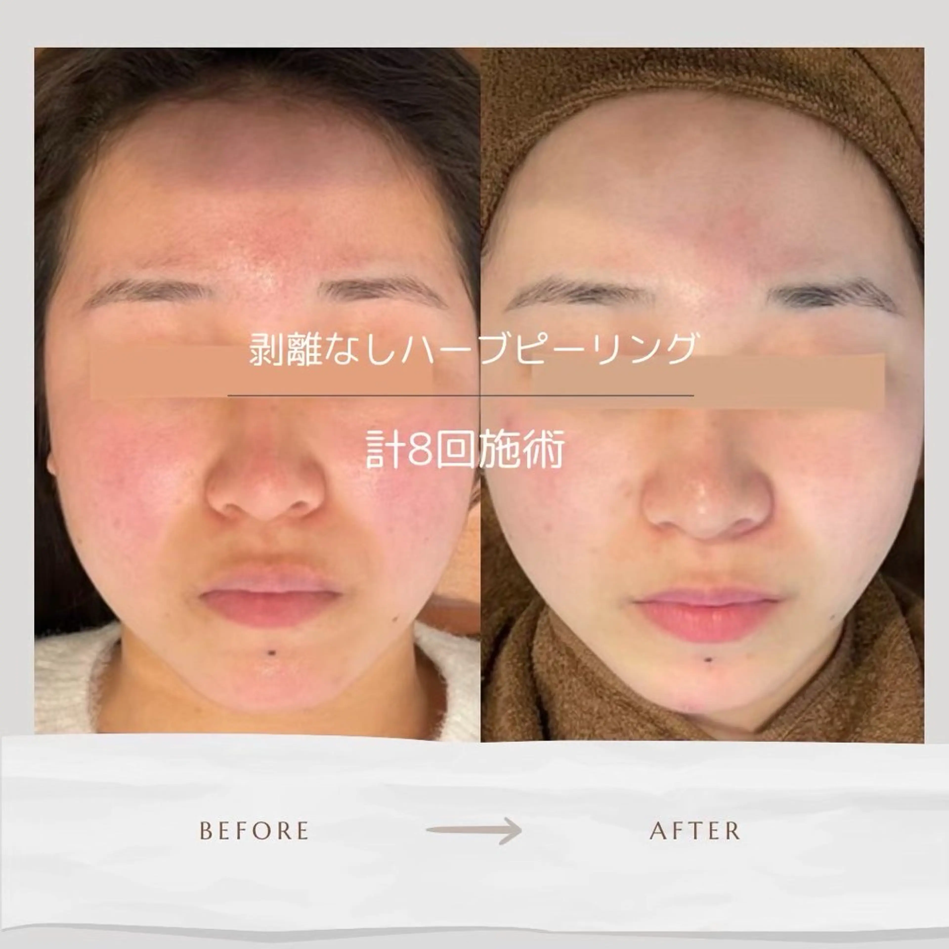 【佐藤限定】🌿オーガニックハーブトリートメント🌿剥離をしたくない方にはこちら☆※1月限定※の写真