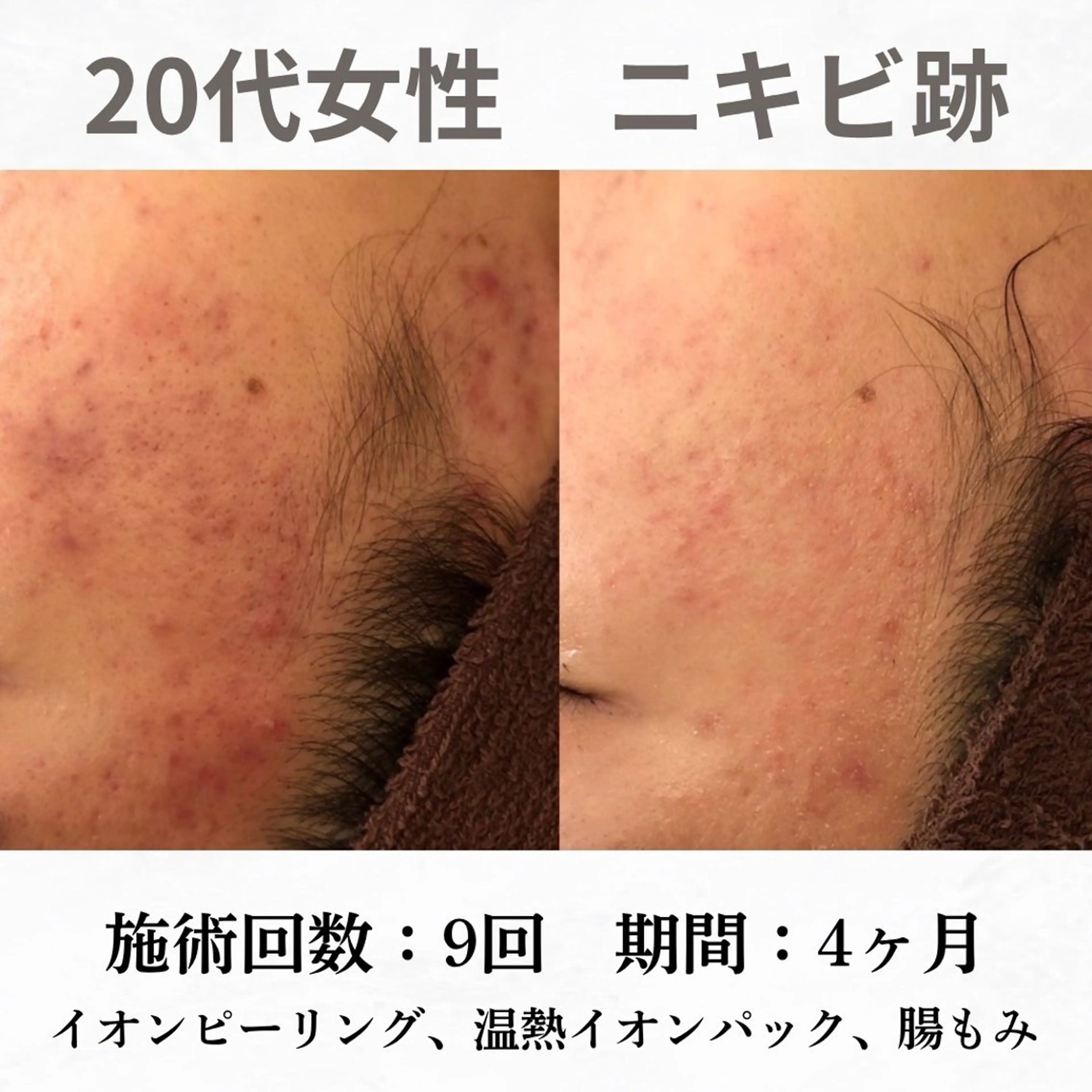 重度ニキビ専門🌷 ダウンタイムなしのエステ・リラクイメージ