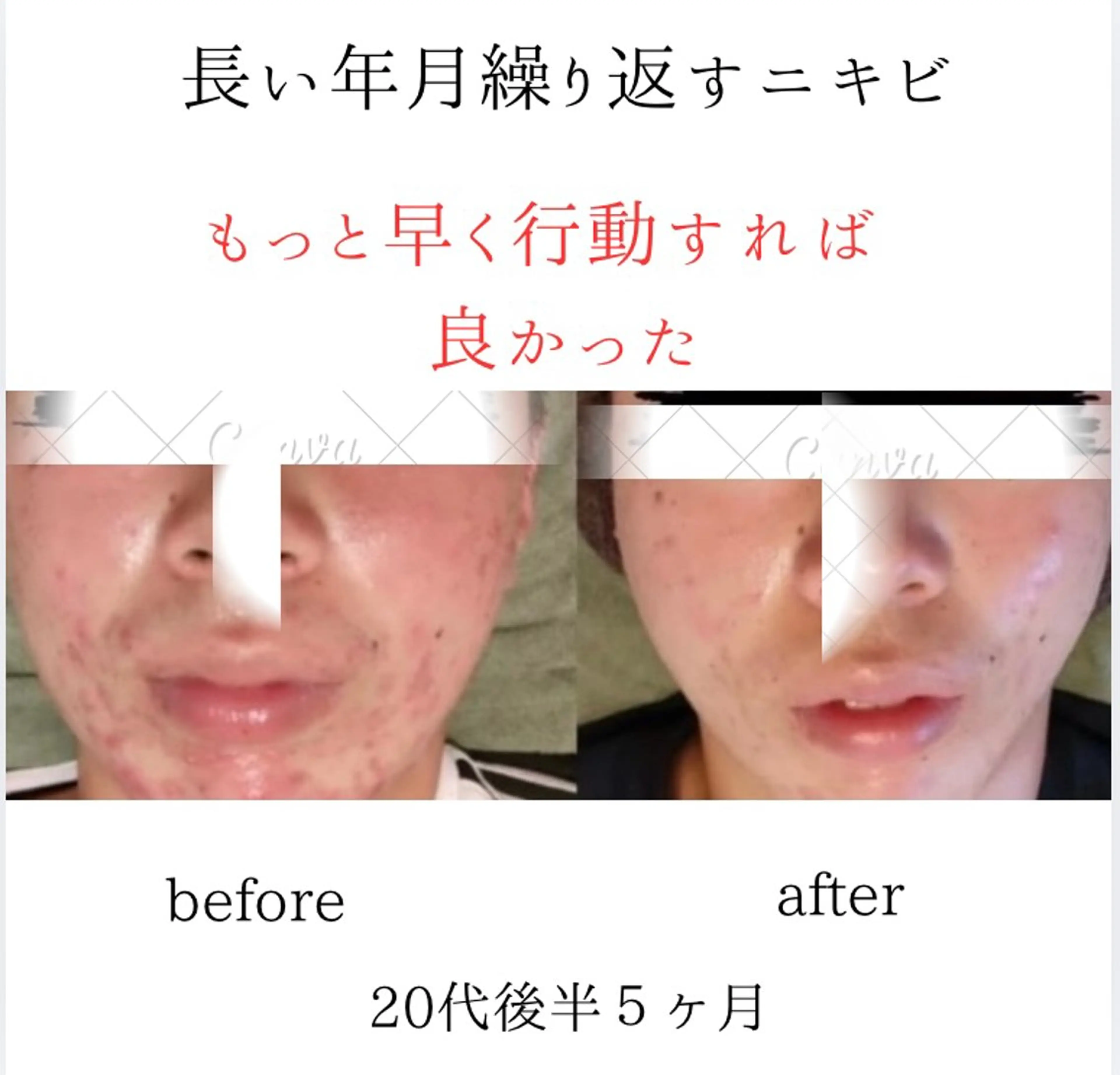 シミニキビ改善 小顔サロンのエステ・リラクイメージ