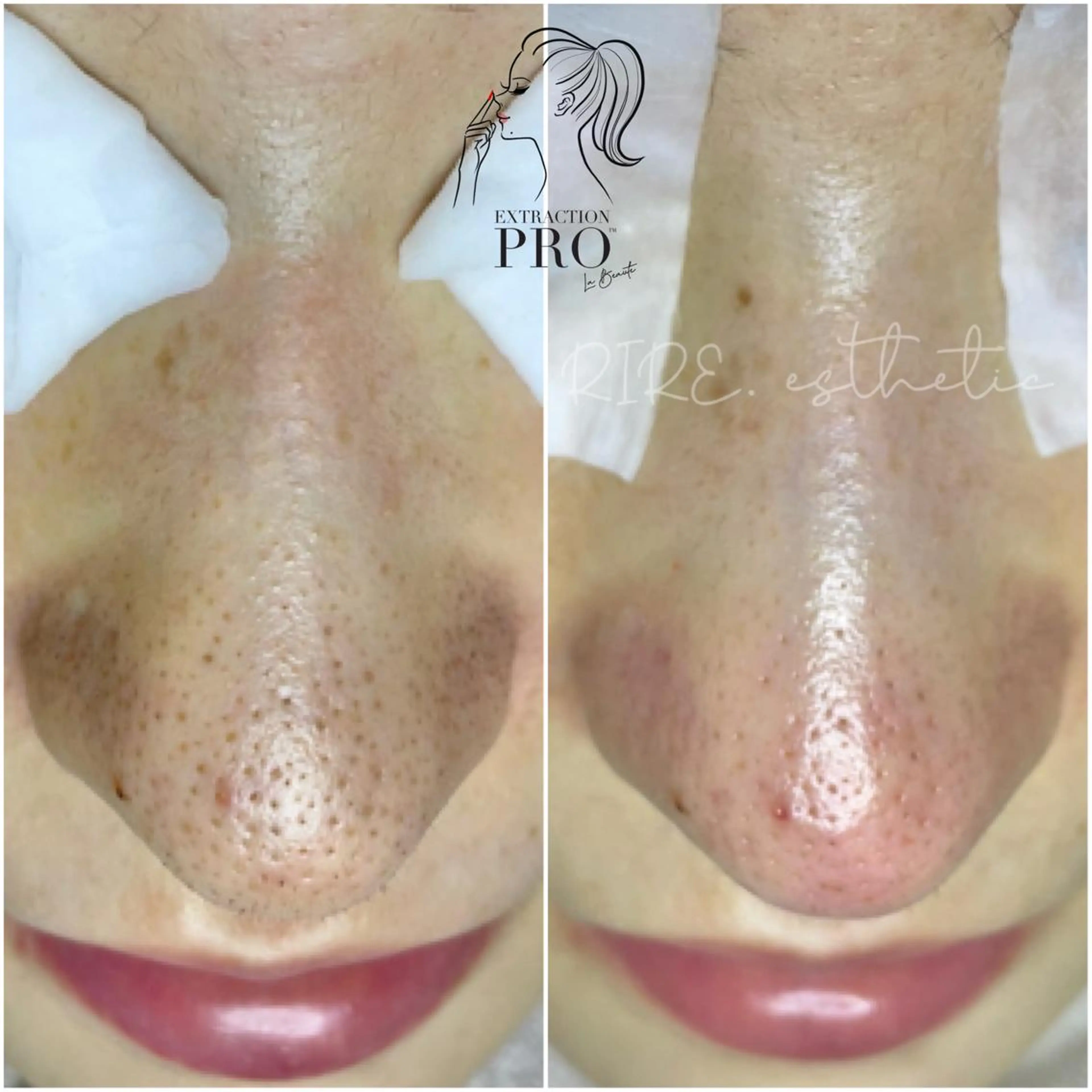 毛穴特化エステ -リールのエステ・リラクイメージ