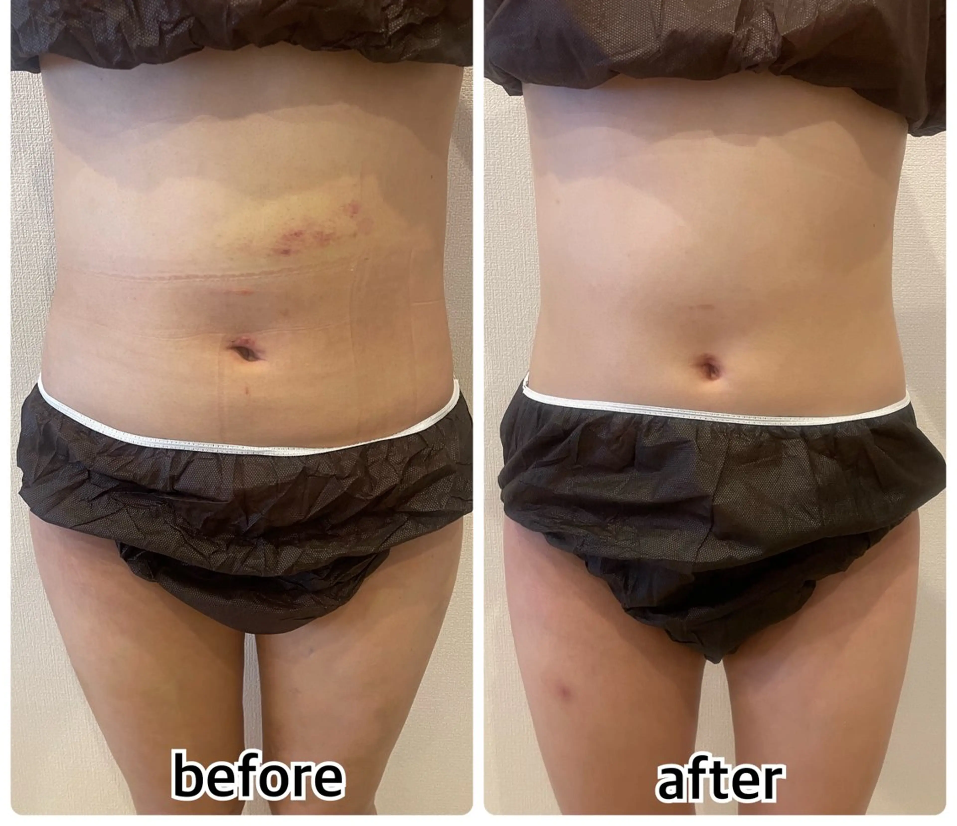 60分コース(1部位)の写真