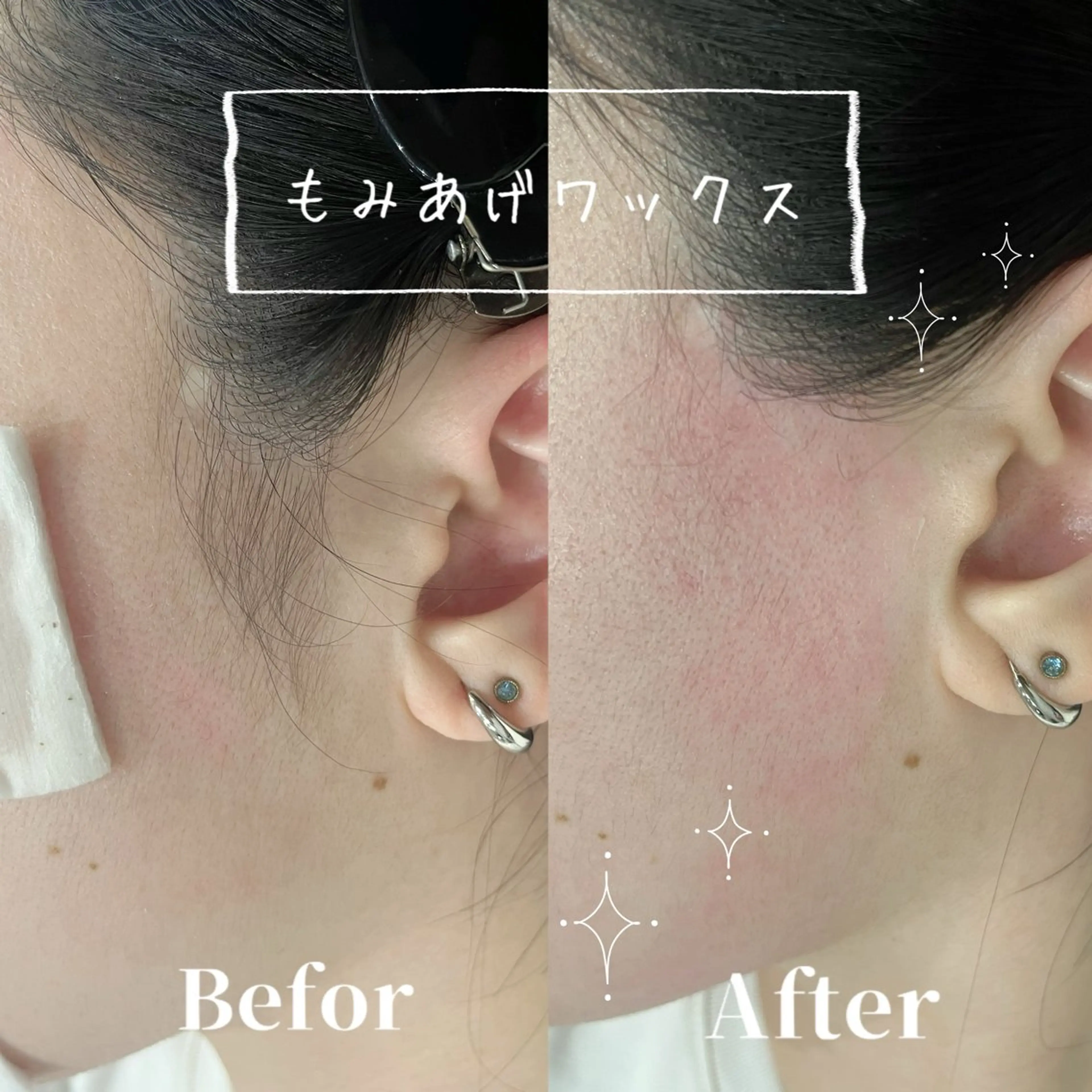 🎀女性限定🎀🫧フルフェイシャルワックス🫧(おでこ•頬•小鼻•口周り•もみあげ)ツルツル卵肌へ🥚✨の写真