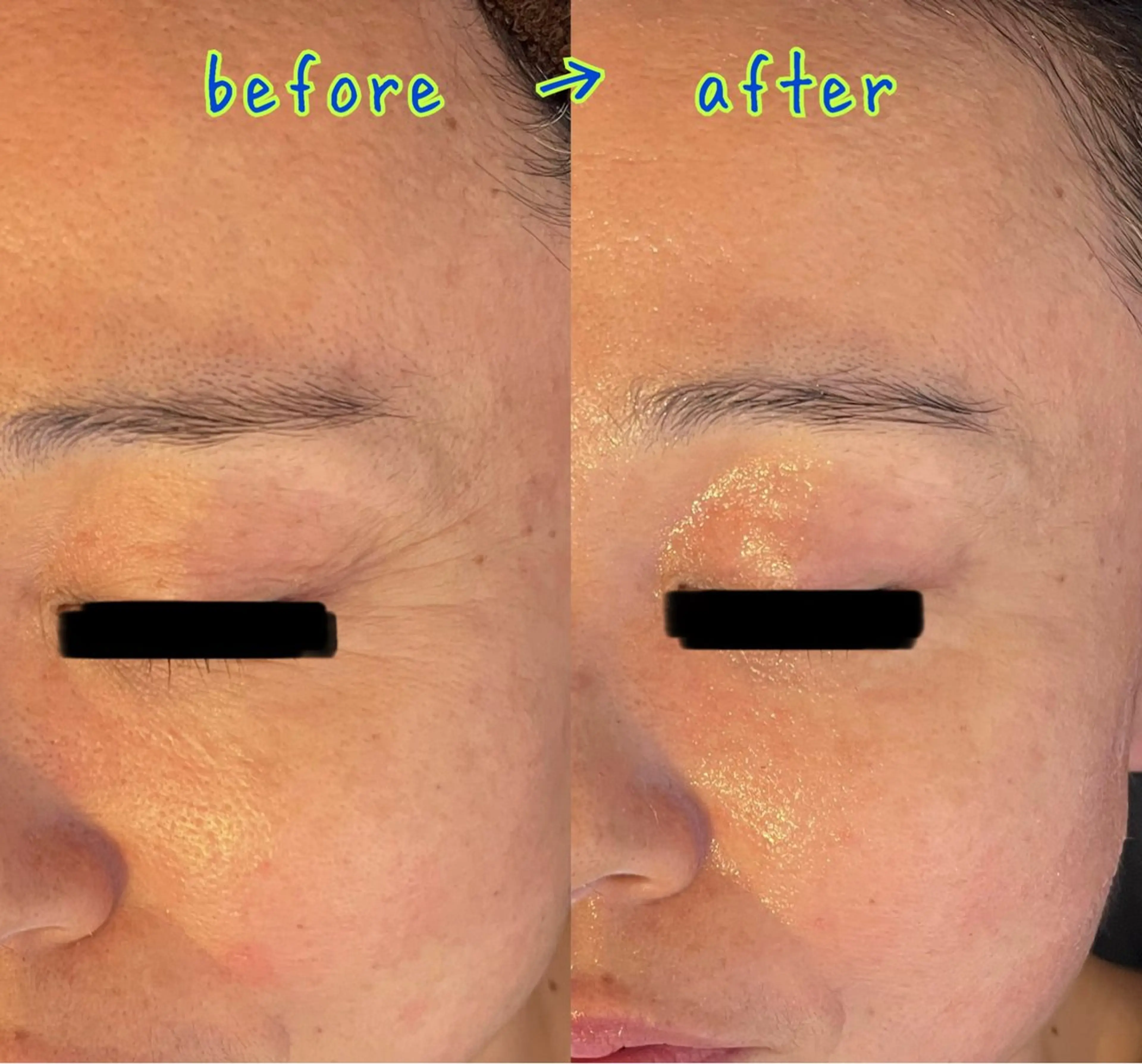 小顔ARTEMIS全顔60分【クレンジング→洗顔→角質除去→ ARTEMIS →デコルテマッサージ→贅沢パック】の写真