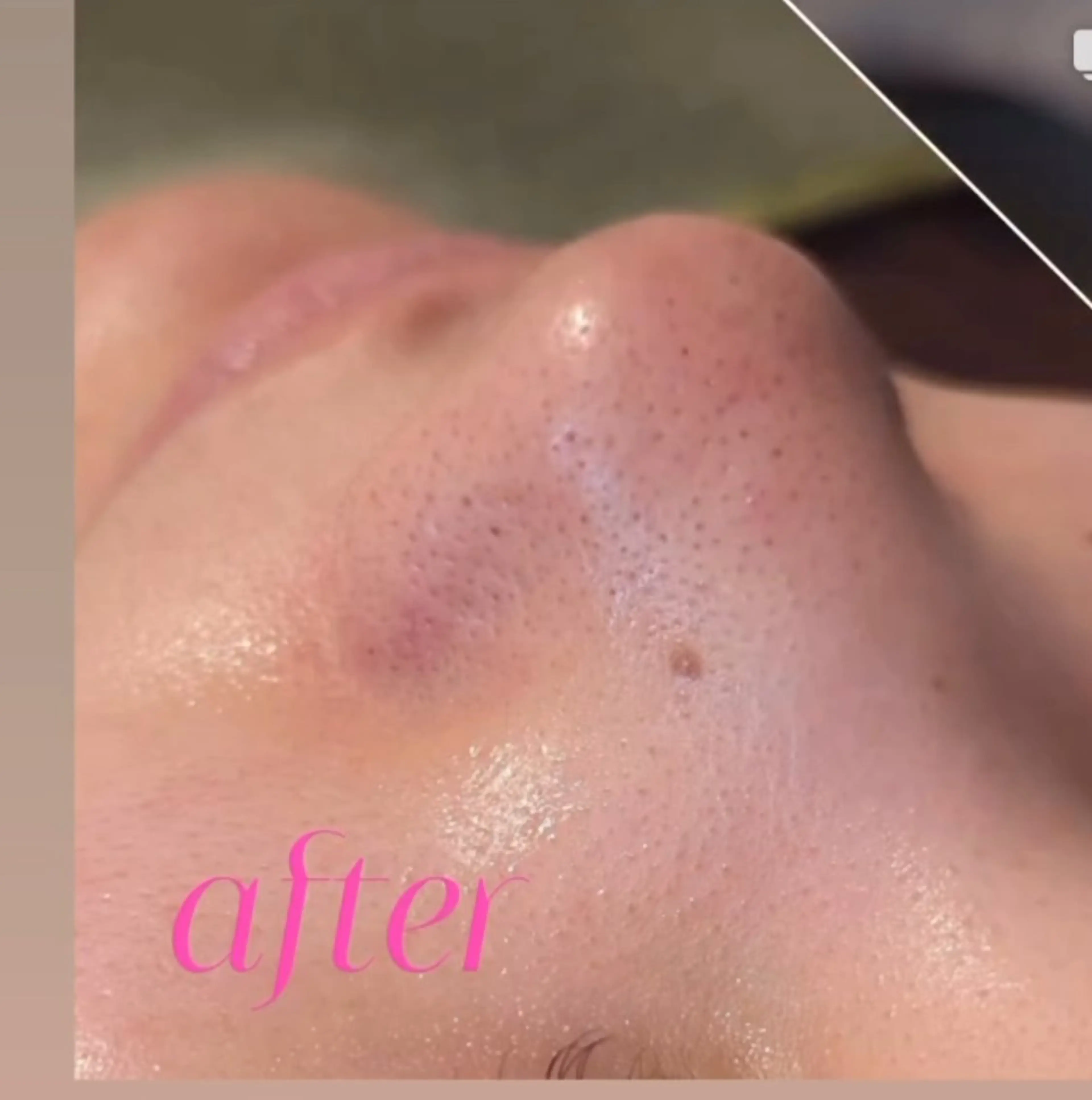 その他 肌質改善BIOELプ ラズマ/ラミピールのエステ・リラクイメージ