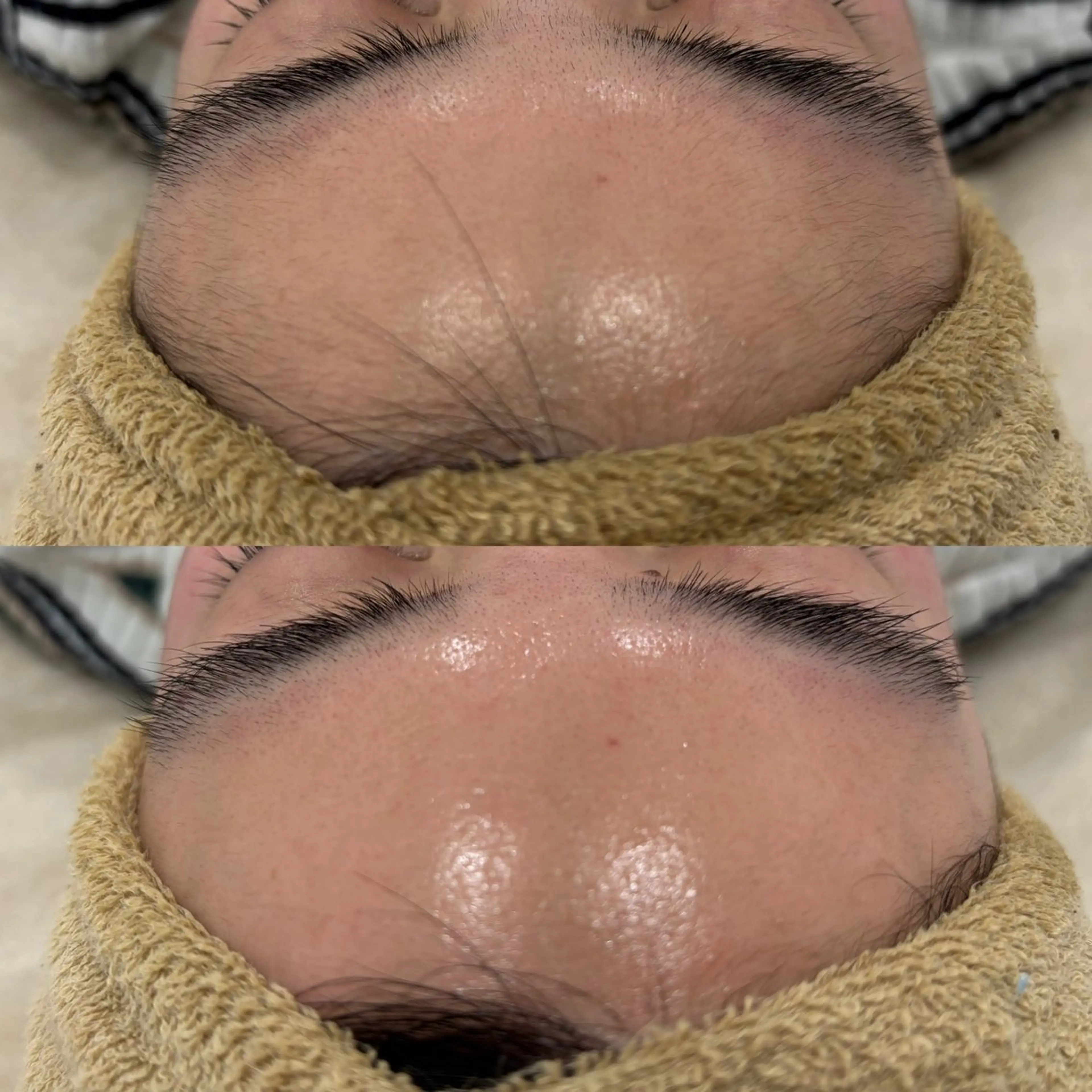 美肌ワックス脱毛（高濃度美容液導入付き）の写真