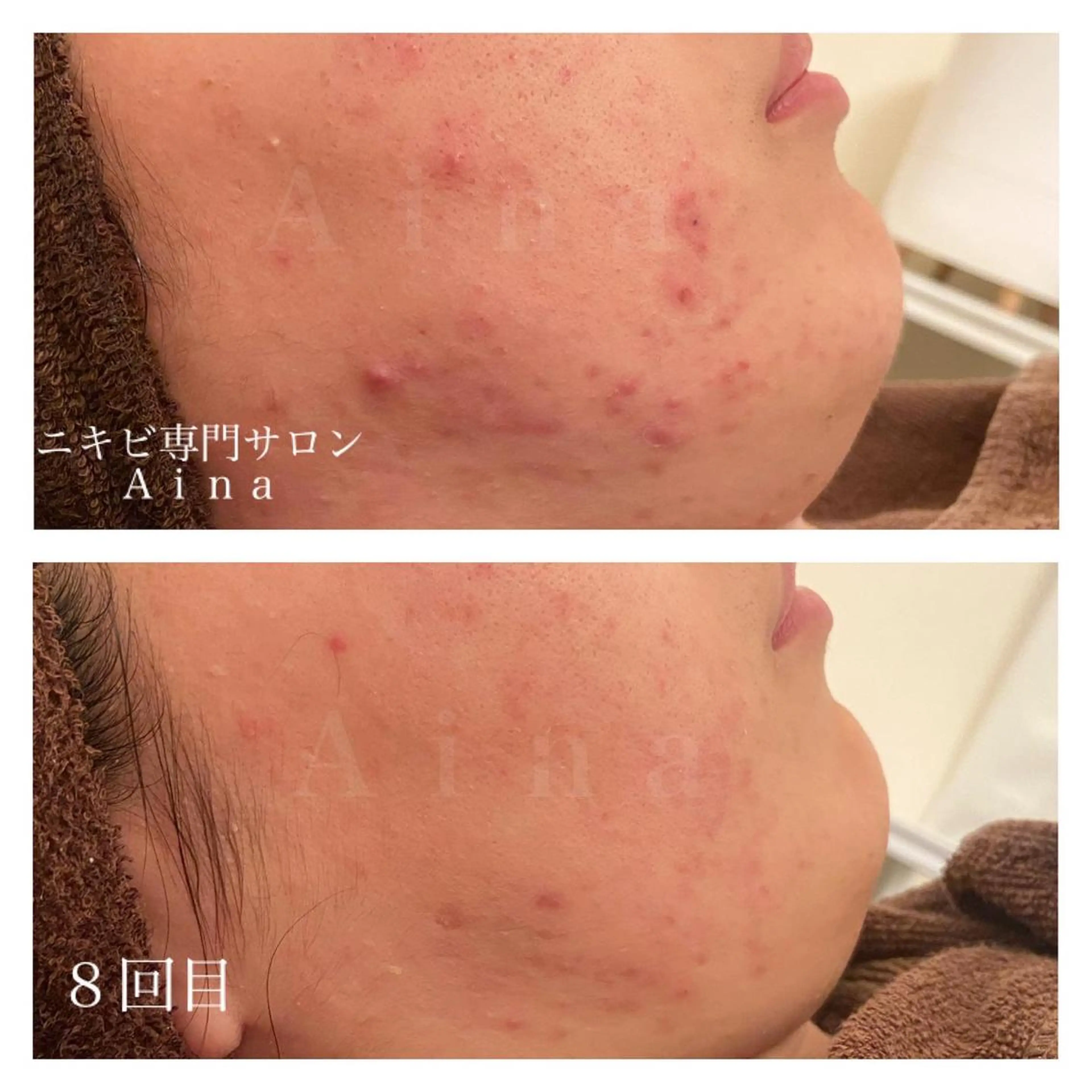 セミロング カラー パーマ ヘアアレンジ メンズ キッズ ネイル マツエク・マツパ エステ リラク ニキビ跡専門サロン Ainaのエステ・リラクイメージ