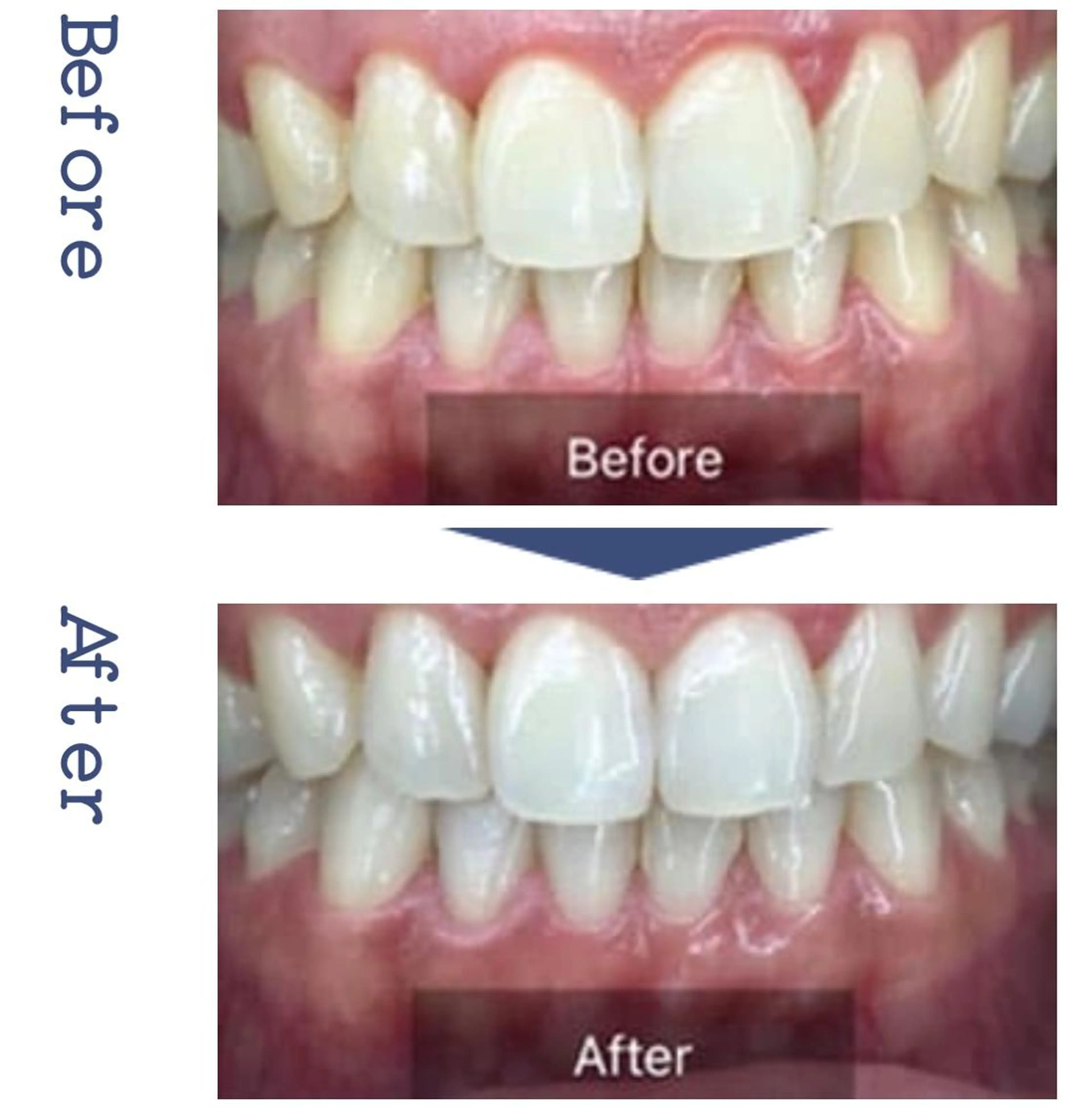 セルフホワイトニング🦷の写真