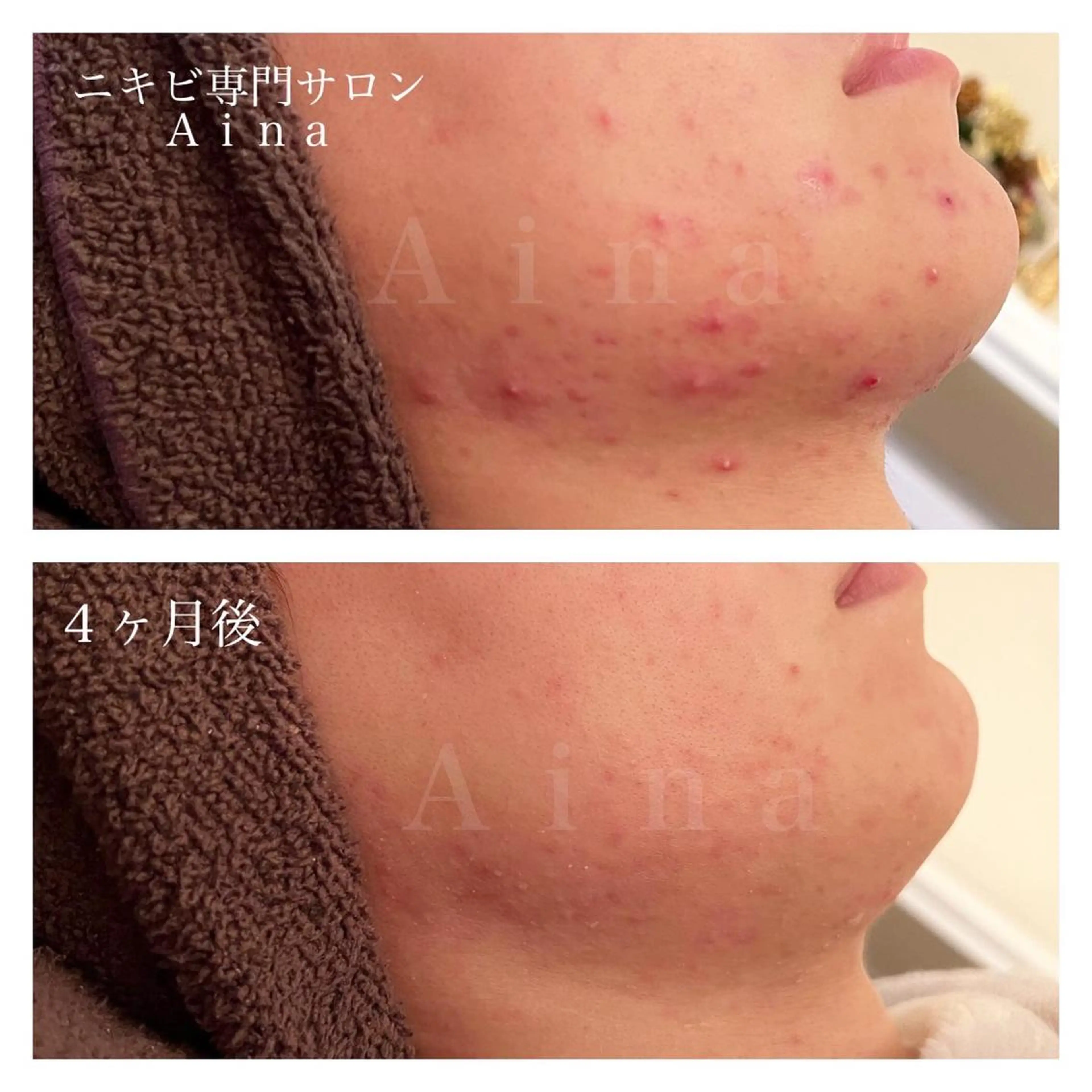 セミロング パーマ ヘアアレンジ メンズ キッズ ネイル マツエク・マツパ アイブロウ ニキビ跡専門サロン Ainaのエステ・リラクイメージ