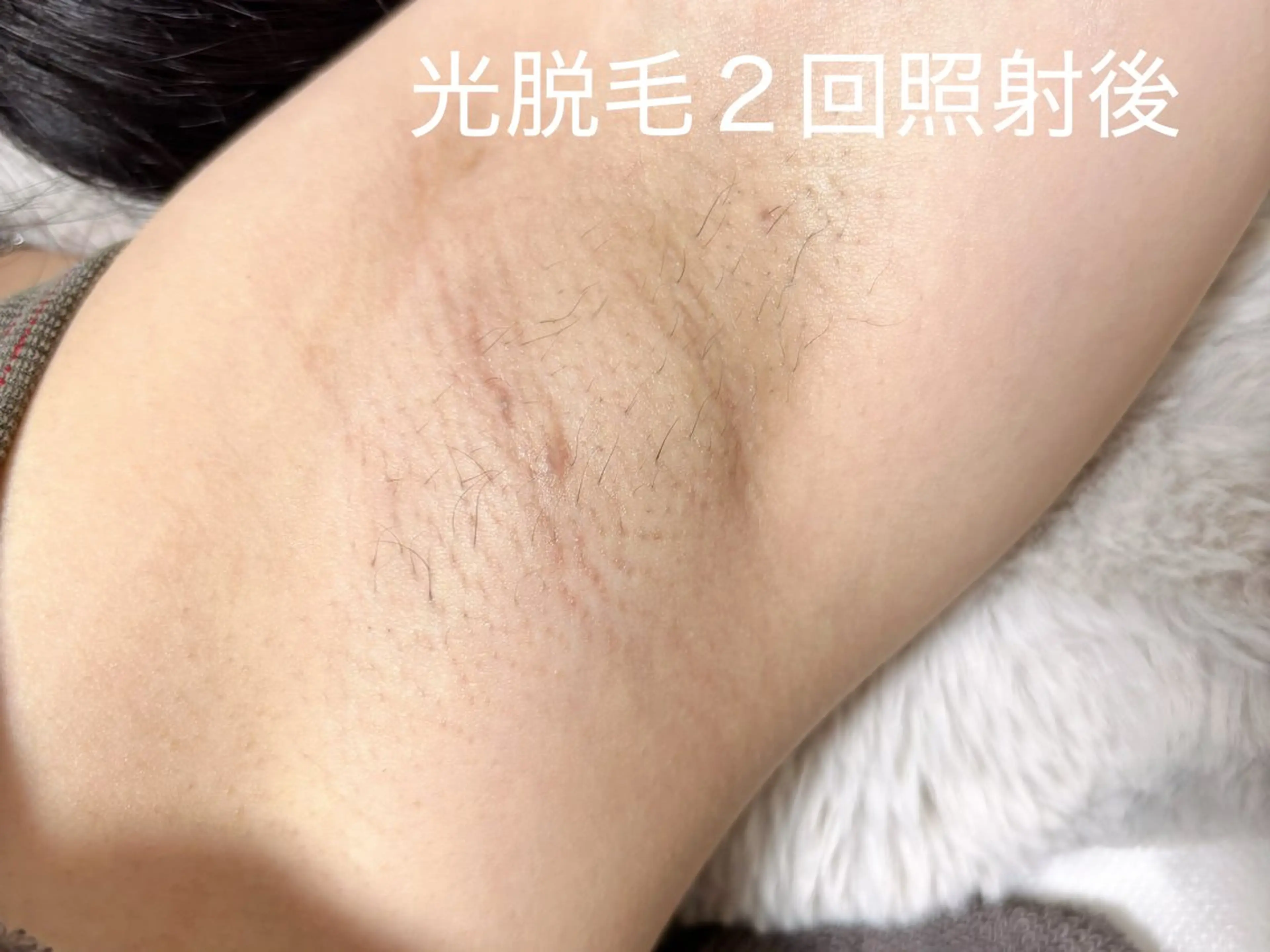 脱毛 PIMIL佐々木 亜里沙のマツエク・マツパデザイン