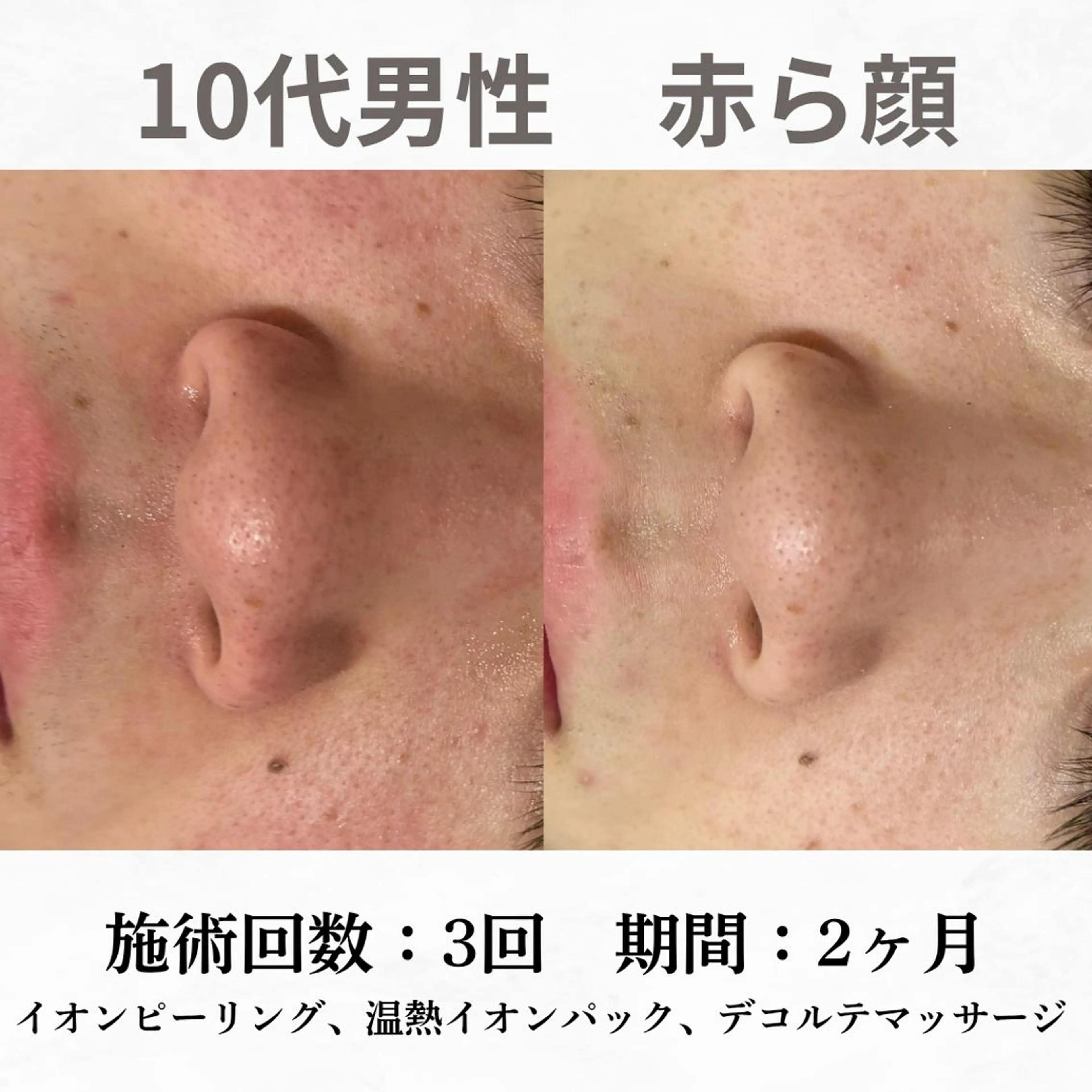 重度ニキビ専門🌷 ダウンタイムなしのエステ・リラクイメージ