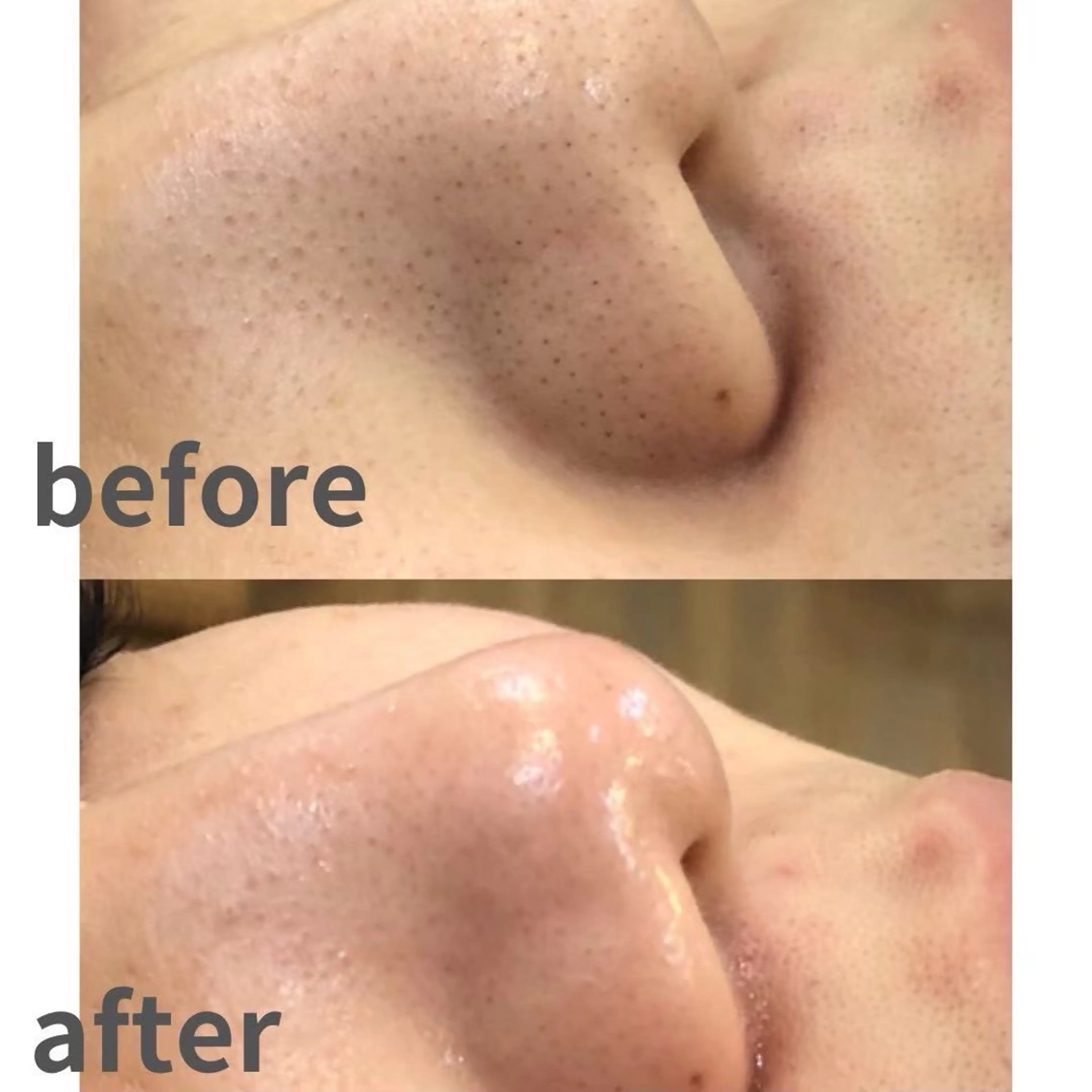 うるツヤお肌に✨🌷毛穴洗浄🌷︎ 1回での効果が凄いから自分のお肌のために、続けたくなる。の写真