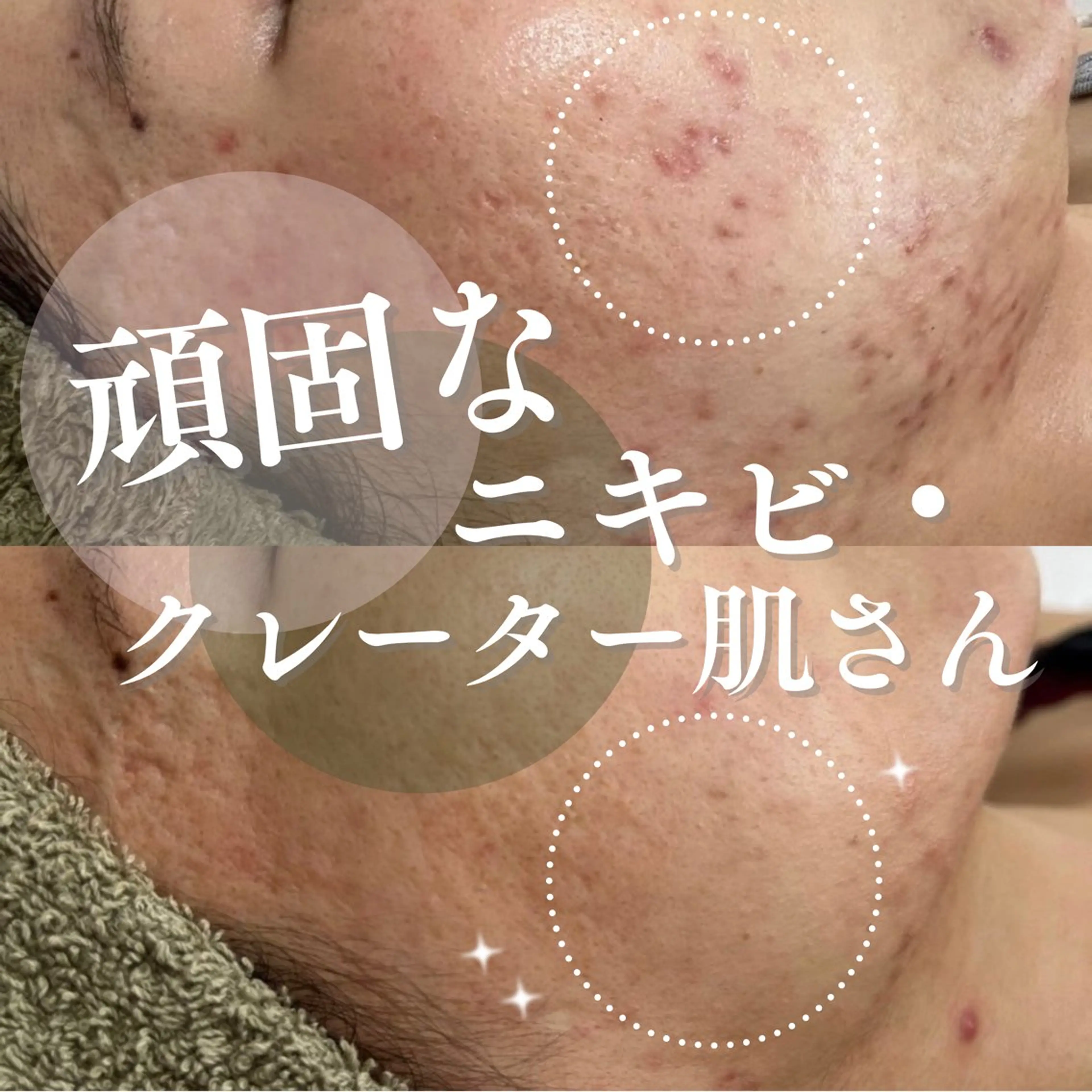 【頑固なニキビ・クレーター肌さん】剥けないハーブピーリング＋セレクト美容液３種＋ipsp幹細胞仕上げ　定価26,950円の写真