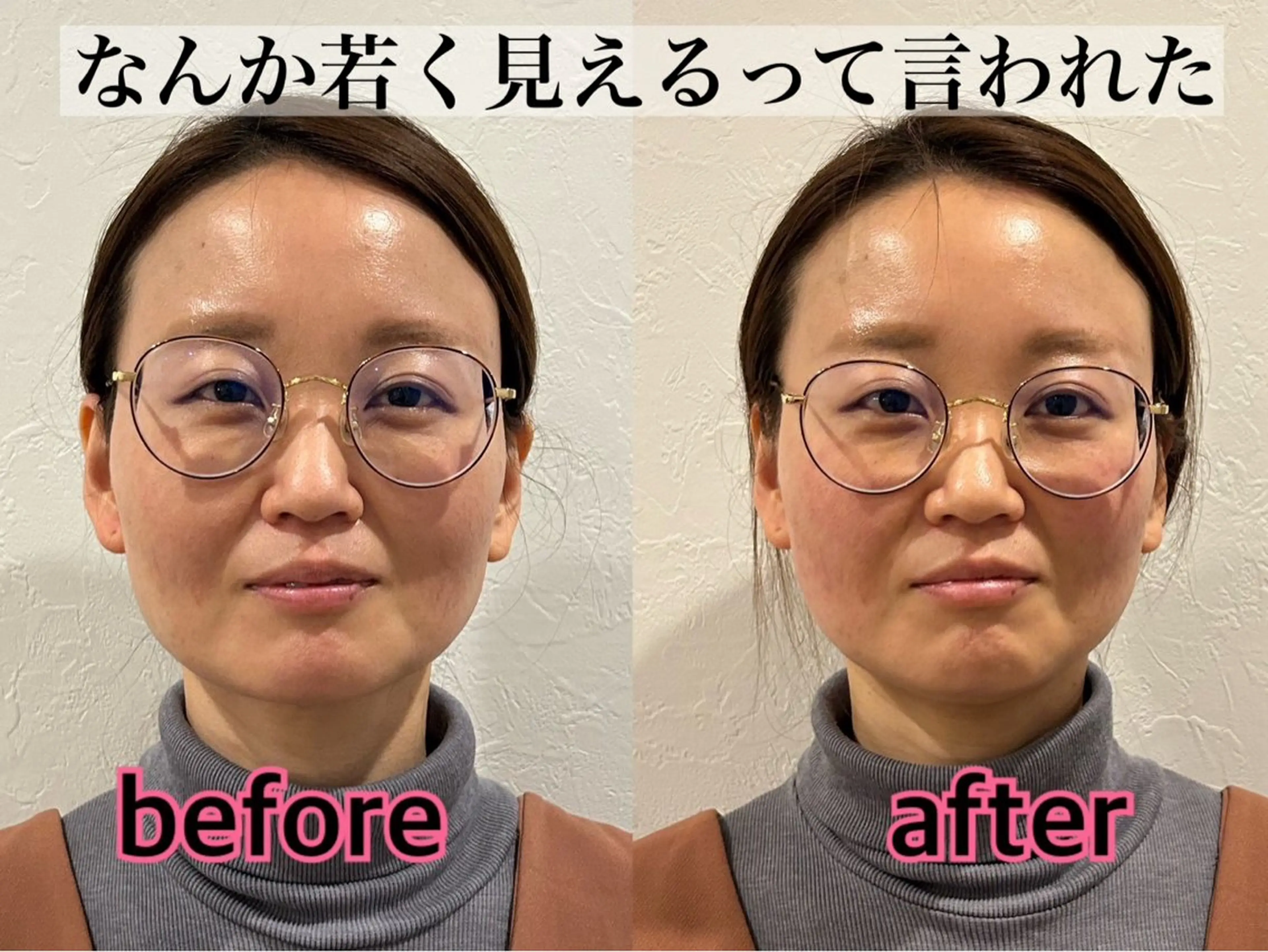 エステ リラク 肌質改善×美容鍼 ゆいのエステ・リラクイメージ
