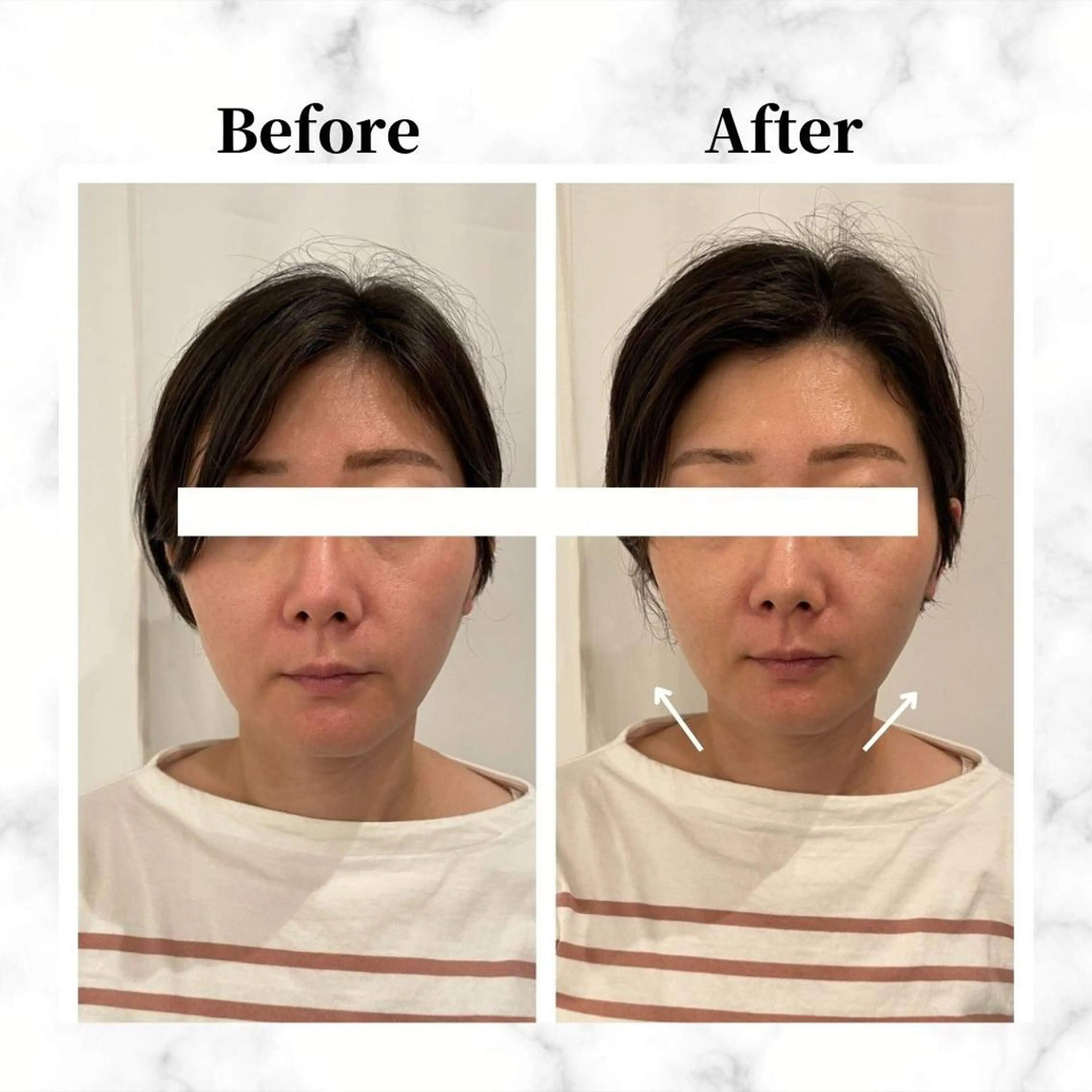 12Dハイフ💗 最強小顔のエステ・リラクイメージ