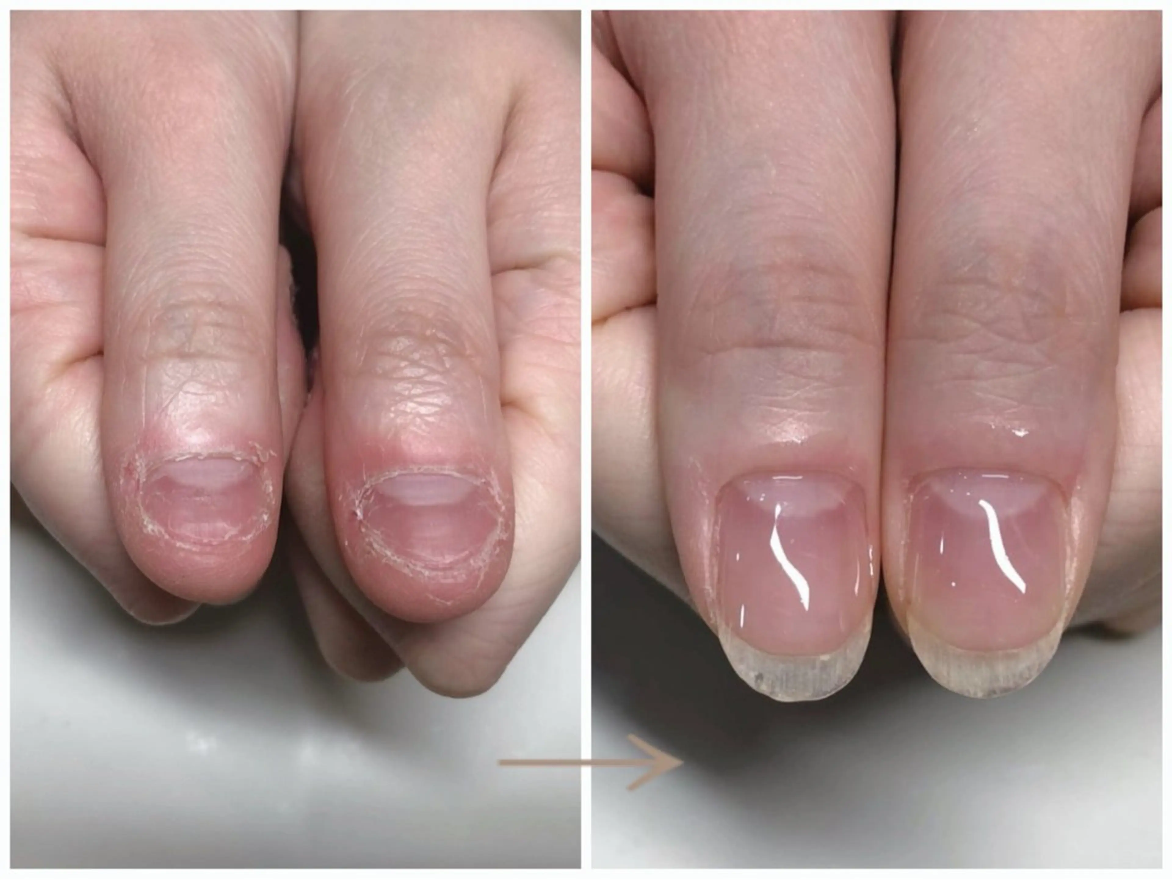 ネイル ピンク 深爪矯正・自爪育成 ヴェールリムのネイルデザイン