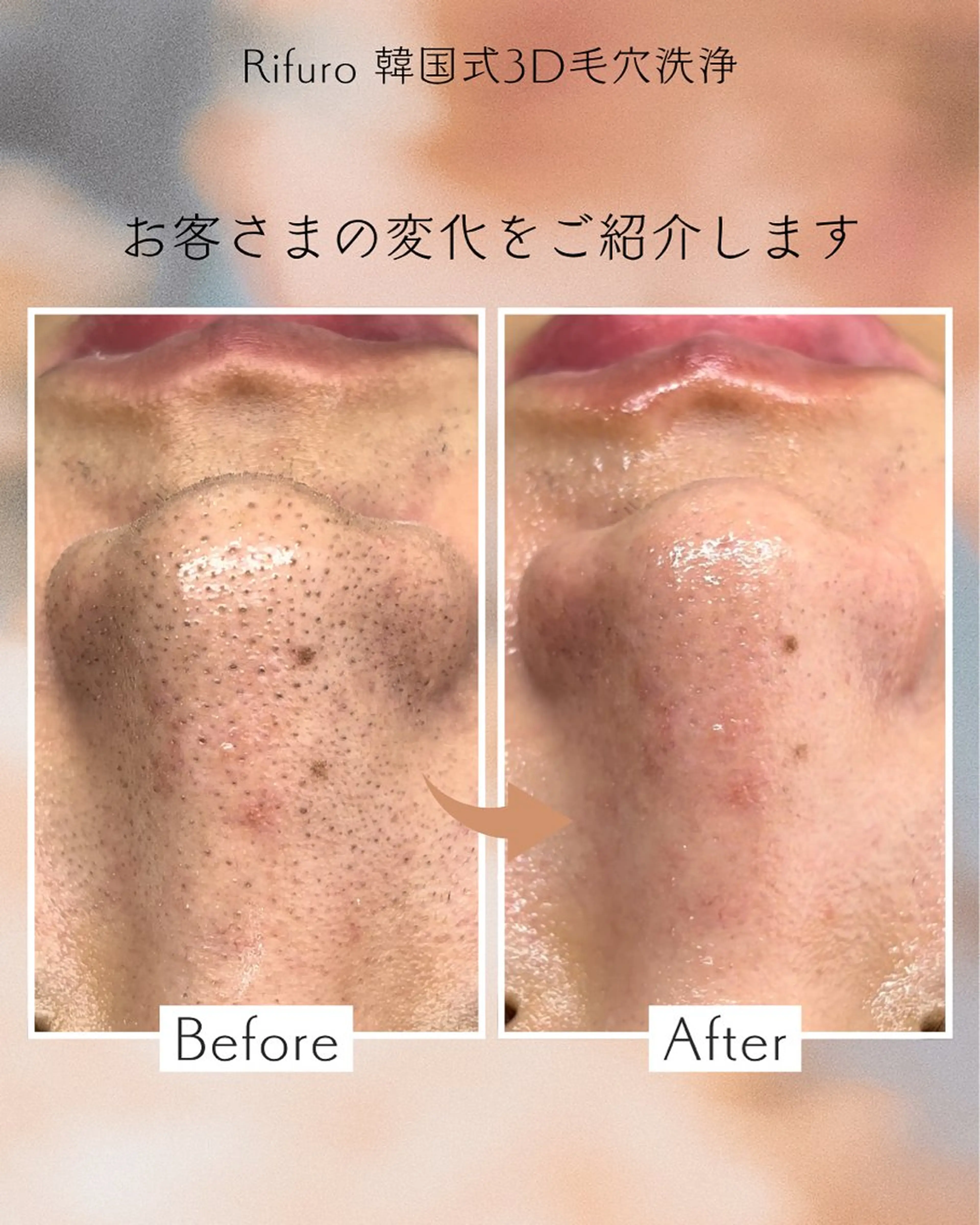Rifuro 勝田台エステ所属・Rifuro勝田台 ララピール・毛穴洗浄のエステ・リラクイメージ