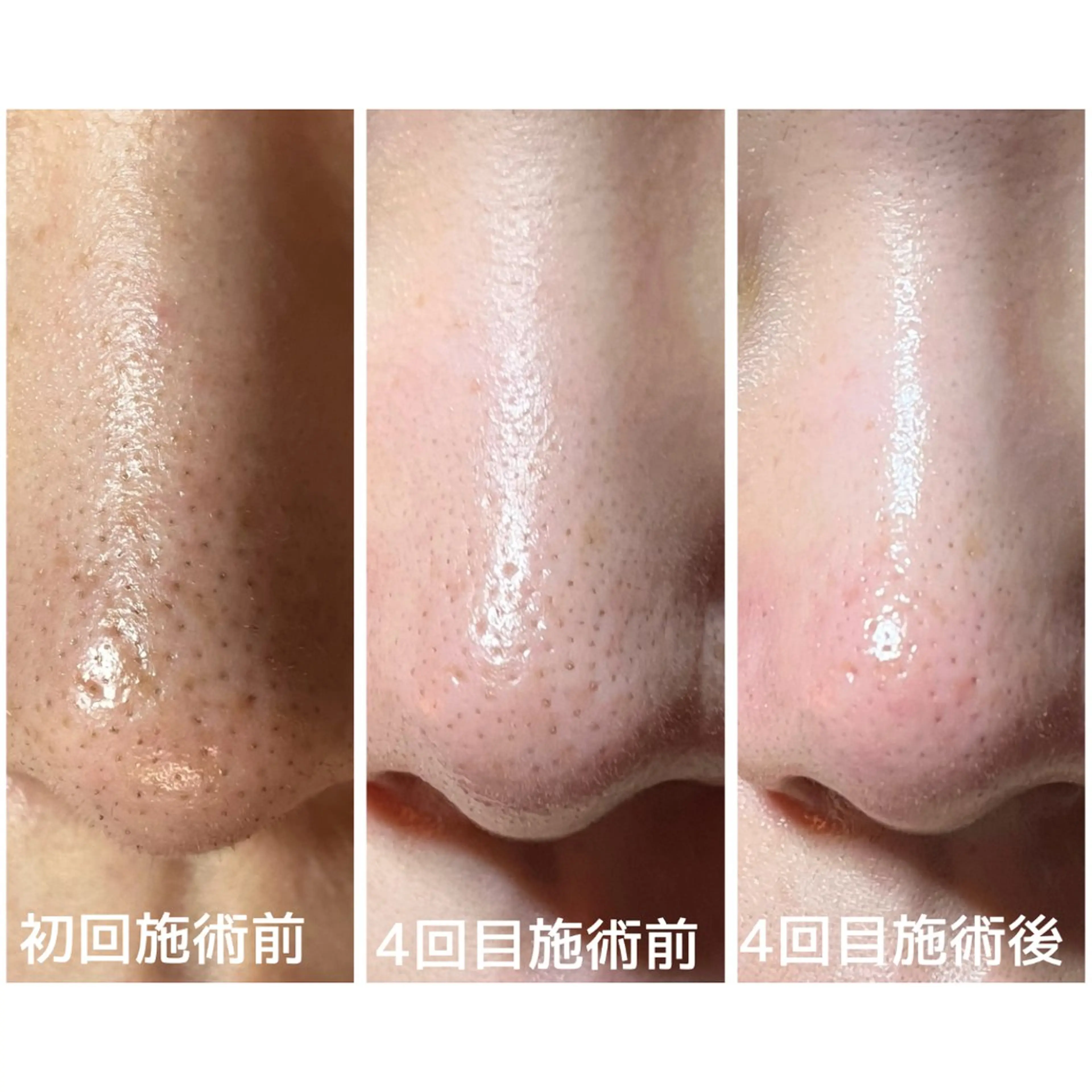 結果重視｜毛穴エステ ｜友綱理恵のエステ・リラクイメージ